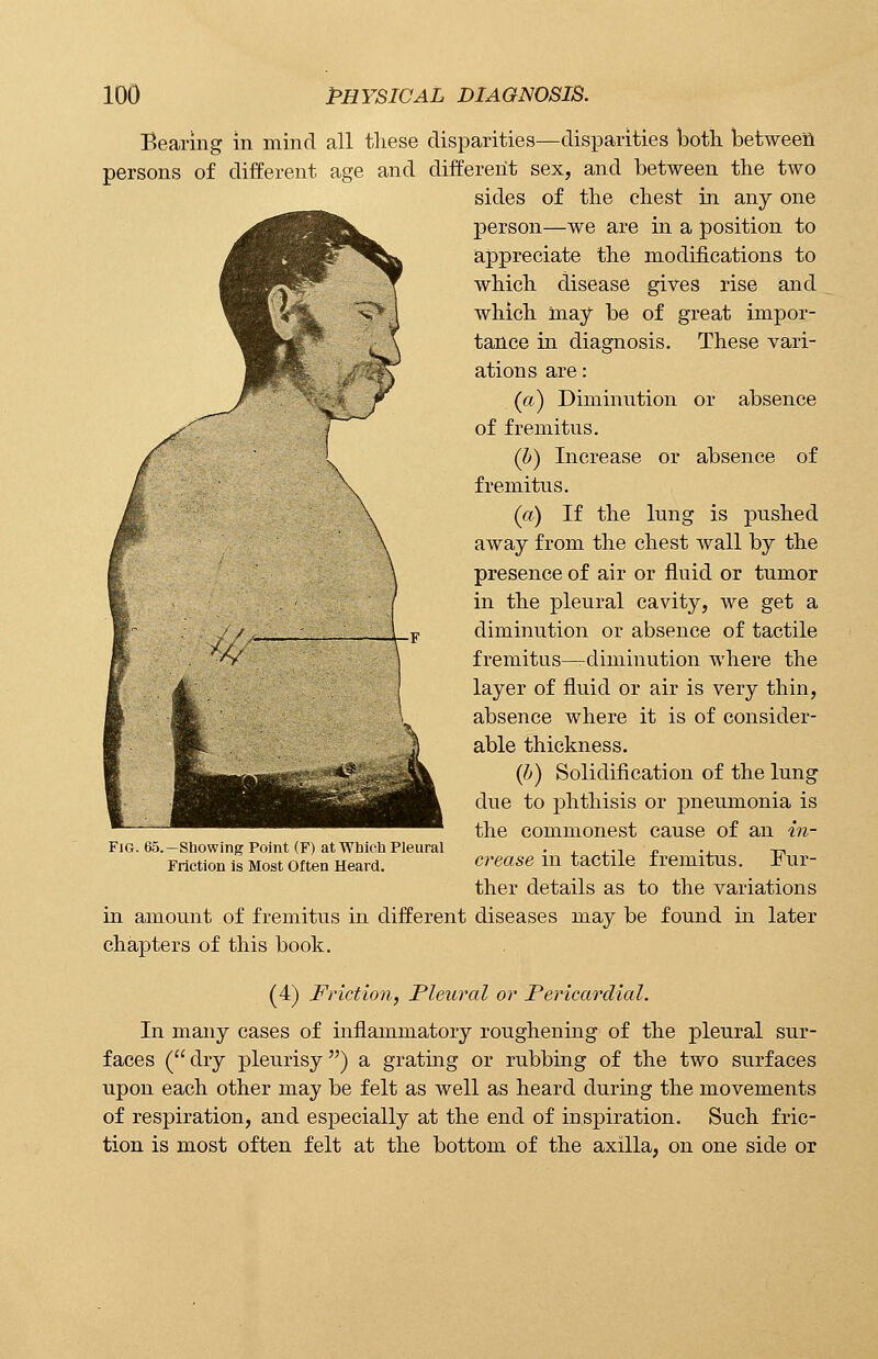 persons Bearing in mind all these disparities—disparities both between of different age and different sex, and between the two sides of the chest in any one person—we are in a position to appreciate the modifications to which disease gives rise and which may be of great impor- tance in diagnosis. These vari- ations are: (a) Diminution or absence of fremitus. (b) Increase or absence of fremitus. (a) If the lung is pushed away from the chest wall by the presence of air or fluid or tumor in the pleural cavity, we get a diminution or absence of tactile fremitus—diminution where the layer of fluid or air is very thin, absence where it is of consider- able thickness. (b) Solidification of the lung due to phthisis or pneumonia is the commonest cause of an in- crease in tactile fremitus. Fur- ther details as to the variations in amount of fremitus in different diseases may be found in later chapters of this book. (4) Friction, Pleural or Pericardial. In many cases of inflammatory roughening of the pleural sur- faces ( dry pleurisy) a grating or rubbing of the two surfaces upon each other may be felt as well as heard during the movements of respiration, and especially at the end of inspiration. Such fric- tion is most often felt at the bottom of the axilla, on one side or Fig. 65.—Showing Point (F) at Which Pleural Friction is Most Often Heard.