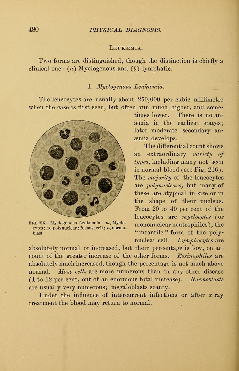 Leukaemia. Two forms are distinguished, though the distinction is chiefly a clinical one: (a) Myelogenous and (&) lymphatic. 1. Myelogenous Leukcemia. The leucocytes are usualty about 250,000 per cubic millimetre when the case is first seen, but often run much higher, and some- times lower. There is no an- aemia in the earliest stages; later moderate secondary an- aemia develops. The differential count shows an extraordinary variety of types, including many not seen in normal blood (see Fig. 216). The majority of the leucocytes are polynuclears, but many of these are atypical in size or in the shape of their nucleus. From 20 to 40 per cent of the leucocytes are myelocytes (or mononuclear neutrophiles), the  infantile  form of the poly- nuclear cell. Lymphocytes are absolutely normal or increased, but their percentage is low, on ac- count of the greater increase of the other forms. Eosinophiles are absolutely much increased, though the percentage is not much above normal. Mast cells are more numerous than in any other disease (1 to 12 per cent, out of an enormous total increase). Normoblasts are usually very numerous; megaloblasts scanty. Under the influence of intercurrent infections or after a?-ray treatment the blood may return to normal. Fig. 216.—Myelogenous Leukaemia, m, Myelo- cytes; p, polynuclear; Z>, mast cell; n, normo blast.