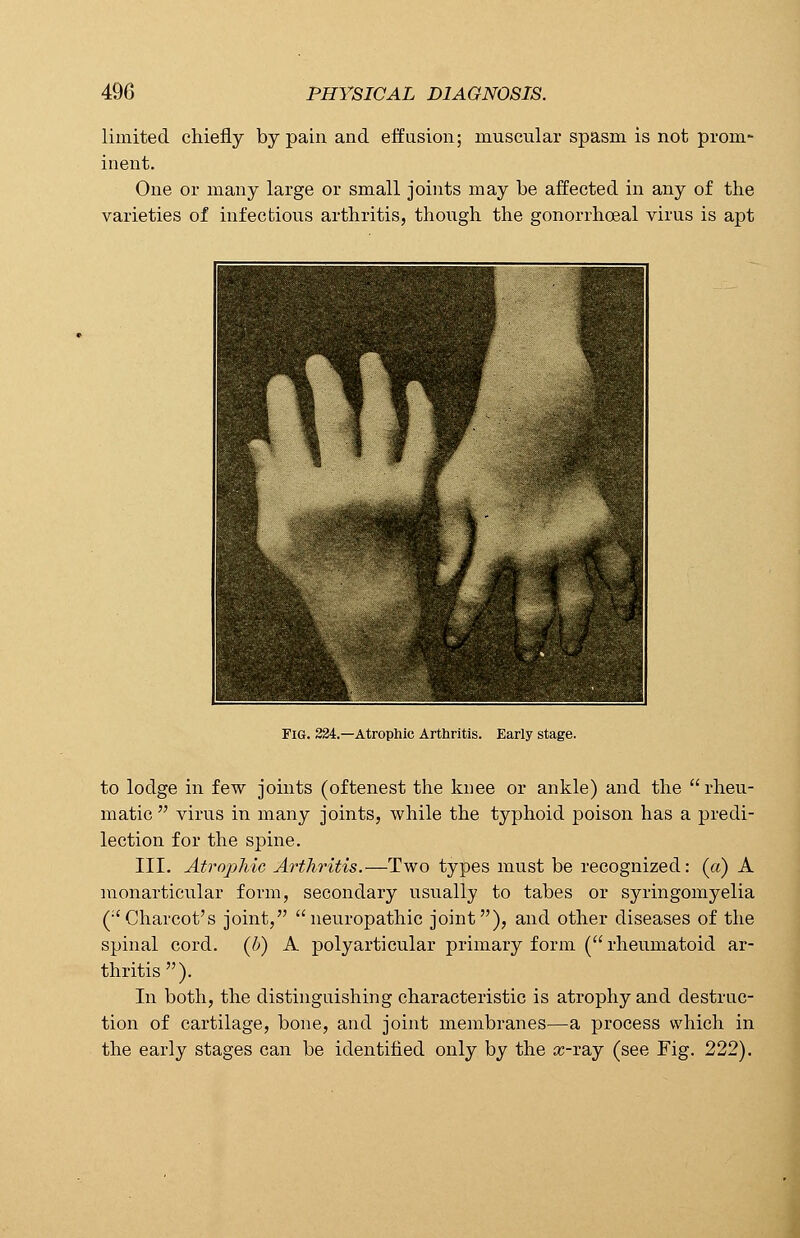 limited chiefly by pain and effusion; muscular spasm is not prom- inent. One or many large or small joints may be affected in any of the varieties of infectious arthritis, though the gonorrhceal virus is apt Fig. 224.—Atrophic Arthritis. Early stage. to lodge in few joints (oftenest the knee or ankle) and the  rheu- matic  virus in many joints, while the typhoid poison has a predi- lection for the spine. III. Atrophic Arthritis.—Two types must be recognized: (a) A monarticular form, secondary usually to tabes or syringomyelia (■'Charcot's joint, neuropathic joint), and other diseases of the spinal cord, (b) A polyarticular primary form ( rheumatoid ar- thritis). In both, the distinguishing characteristic is atrophy and destruc- tion of cartilage, bone, and joint membranes—a process which in the early stages can be identified only by the cc-ray (see Fig. 222).