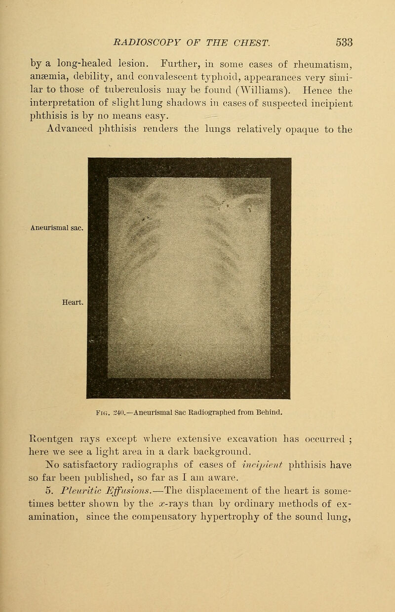 by a long-healed lesion. Further, in some cases of rheumatism, anaemia, debility, and convalescent typhoid, appearances very simi- lar to those of tuberculosis may be found (Williams). Hence the interpretation of slight lung shadows in cases of suspected incipient phthisis is by no means easy. Advanced phthisis renders the lungs relatively opaque to the A.neurismal sac. Heart. Fi«. 24(1.— Aneurismal Sac Radiographed from Behind. Roentgen rays except where extensive excavation has occurred ; here we see a light area in a dark background. No satisfactory radiographs of cases of incipient phthisis have so far been published, so far as I am aware. 5. Pleuritic Effusions.—The displacement of the heart is some- times better shown by the sc-rays than by ordinary methods of ex- amination, since the compensatory hypertrophy of the sound lung,