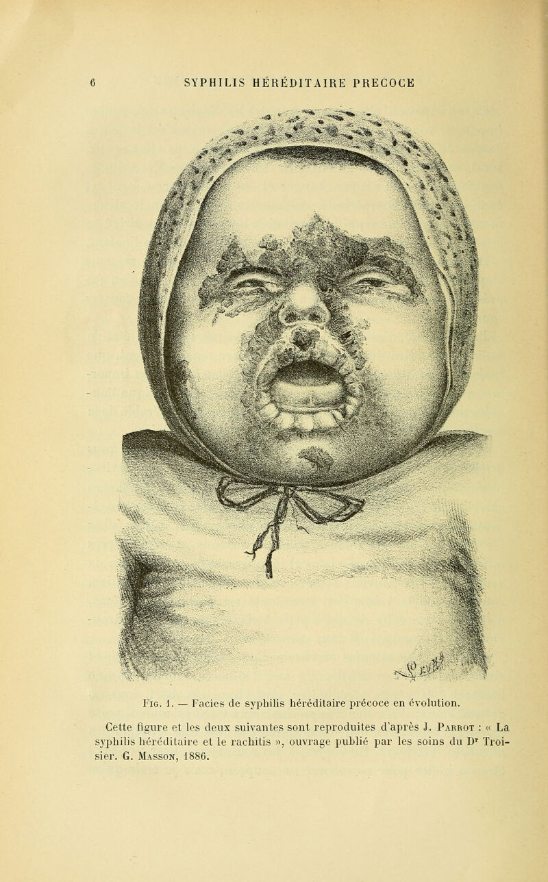 FiG. 1. — Faciès de syphilis héréditaire précoce en évolution. Cette figure et les deux suivantes sont reproduites d'après J. Parbot : « La syphilis héréditaire et le rachitis », ouvrage publié par les soins du D'' Troi- sier. G. Masson, 1886.