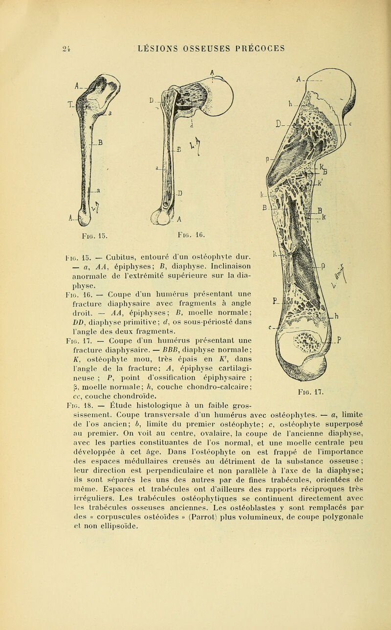 D--, FiG. 15. FiG. 15. — Cubitus, entouré d'un ostéophyte dur. — a, AA, épiphyses; B, diaphyse. Inclinaison anormale de Textrémité supérieure sur la dia- physe. FiG. 16. — Coupe d'un humérus présentant une fracture diaphysaire avec fragments à angle droit. — AA, épiphyses; B, moelle normale; DD, diaphyse primitive ; cl, os sous-péiiosté dans l'angle des deux fragments. FiG. 17. — Coupe d'un humérus présentant une fracture diaphysaire. — BBB, diaphyse normale; K, ostéophyte mou, très épais en K', dans l'angle de la fracture; A, épiphyse cartilagi- neuse ; P, point d'ossification épiphysaire ; p, moelle normale; h, couche chondro-calcaire; ce, couche chondroïde. FiG. 18. — Étude histologique à un faible gros- sissement. Coupe transversale d'un humérus avec ostéophytes. — a, limite de l'os ancien; b, limite du premier ostéophyte; c, ostéophyte superposé au premier. On voit au centre, ovalaire, la coupe de l'ancienne diaphyse, avec les parties constituantes de l'os normal, et une moelle centrale peu développée à cet âge. Dans l'ostéophyte on est frappé de l'importance des espaces médullaires creusés au détriment de la substance osseuse ; leur direction est perpendiculaire et non parallèle à l'axe de la diaphyse; ils sont séparés les uns des autres par de fines trabécules, orientées de même. Espaces et trabécules ont d'ailleurs des rapports récipi^oques très irréguliers. Les trabécules ostéophytiques se continuent directement avec les trabécules osseuses anciennes. Les ostéoblastes y sont remplacés par des « corpuscules ostéoïdes » (Parrot) plus volumineux, de coupe polygonale et non ellipsoïde.