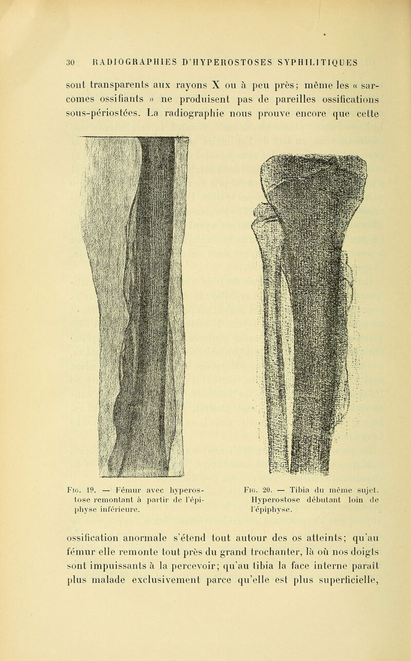 sont transparents aux rayons X ou à peu près ; même les « sar- comes ossifiants » ne produisent pas de pareilles ossifications sous-périostées. La radiographie nous prouve encore que cette FiG. 19. — Fémur avec hyperos- tose remontant à partir de l'épi- physe inférieure. Fio. 20. — Tibia du même sujet. Hyperostose débutant loin de l'épiphyse. ossification anormale s'étend tout autour des os atteints; qu'au fémur elle remonte tout près du grand trochanter, là où nos doigts sont impuissants à la percevoir; qu'au tibia la face interne paraît plus malade exclusivement parce qu'elle est plus superficielle,