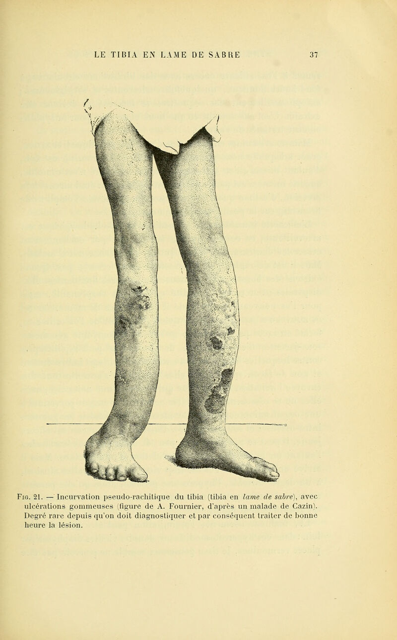 FiG. 21. — Incurvation pseudo-rachitique du tibia (tibia en lame de sabre), avec ulcérations gommeuses (figure de A. Fournier, d'après un malade de Cazin). Degré rare depuis qu'on doit diagnostiquer et par conséquent traiter de bonne heure la lésion.