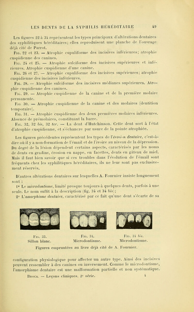 Les figures 22 k 34 représentent les types principaux traltérations dentaires des syphilitiques hére'ditaires; elles reproduisent une planche de l'ouvi^age déjà cité de Parrot. FiG. 22 et 23. —Atrophie cupuliforme des incisives inférieures; atrophie cuspidienne des canines. EiG. 24 et 2d. — Atrophie sulciforme des incisives supérieures et infé- rieures. Atrophie cuspidienne d'une canine. FiG. 26 et 27. — Atrophie cupuliforme des incisives supérieures; atrophie cuspidienne des incisives inférieures. FiG. 28. — Atrophie sulciforme des incisives médianes supérieures. Atro- phie cuspidienne des canines. FiG. 29. — Atrophie cuspidienne de la canine et de la première molaire permanente. Yio. 30. — Atrophie cuspidienne de la canine et des molaires (dentition temporaire). FiG. 31. — Atrophie cuspidienne des deux premières molaires inférieures. Absence de prémolaires, constituant la barre. FiG. 32, 32 bis, 32 ter. — La dent d'IIutchinson. Cette dent sort à l'état d'atrophie cuspidienne, et s'échancre par usure de la pointe atrophiée. Les figures précédentes représentent les types de Vérosi'iti dentaire, c'est-à- dire où il y a non-formation de l'émail et de l'ivoire au niveau de la dépression. Du degré de la lésion dépendent certains aspects, caractérisés par les noms de dents en gradins, érosion en nappe, en facettes, dents en gâteau de miel. Mais il faut bien savoir que si ces troubles dans l'évolution de l'émail sont fréquents chez les syphilitiques héréditaires, ils ne leur sont pas exclusive- ment réservés. D'autres altérations dentaires sur lesquelles A. Fournier insiste longuement sont : 1° Le microdontisme, limité presque toujours à quelques dents, parfois aune seule. Le nom suffit à la description (fig. 34 et 34 Us) ; 2° Vamorphisme dentaire, caractérisé par ce fait qu'une dent s'écarte de sa Fig. 33. Sillon blanc. Fig. 34. Microdontisme. Fig. 34 bis. Microdontisme. Figures empruntées au livre déjà cité de A. Fournier. configuration physiologique pour affecter un autre type. Ainsi des incisives peuvent ressembler à des canines ou inversement. Comme le microdontisme, l'amorphisme dentaire est une malformation partielle et non systématique. Broca. — Leçons cliniques, 2« série. 4