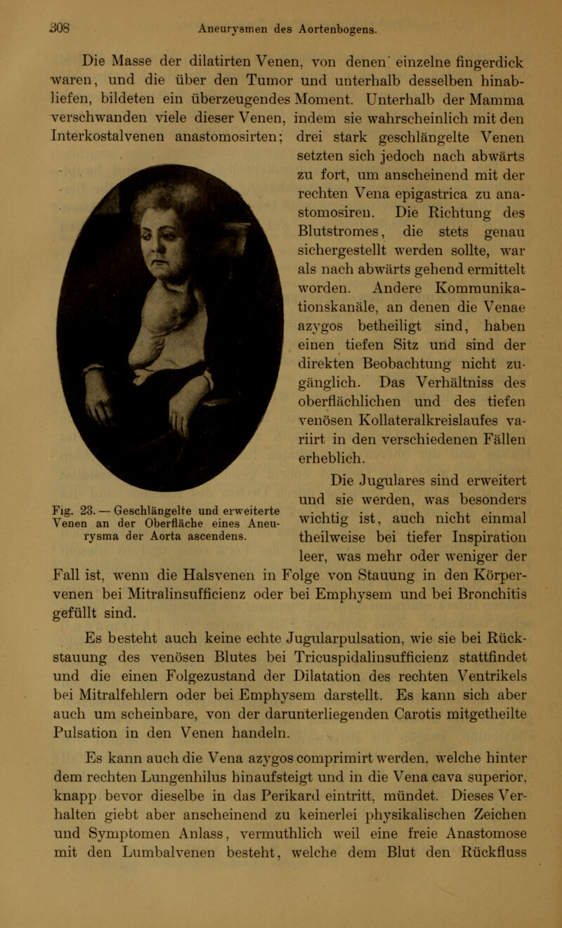 Die Masse der dilatirten Venen, von denen' einzelne fingerdick •waren, und die über den Tumor und unterhalb desselben hinab- liefen, bildeten ein überzeugendes Moment. Unterhalb der Mamma verschwanden viele dieser Venen, indem sie wahrscheinlich mit den Interkostalvenen anastomosirten; drei stark geschlängelte Venen setzten sich jedoch nach abwärts zu fort, um anscheinend mit der rechten Vena epigastrica zu ana- stomosiren. Die Richtung des Blutstromes, die stets genau sichergestellt werden sollte, war als nach abwärts gehend ermittelt worden. Andere Kommunika- tionskanäle, an denen die Venae azygos betheiligt sind, haben einen tiefen Sitz und sind der direkten Beobachtung nicht zu- gänglich. Das Verhältniss des oberflächlichen und des tiefen venösen Kollateralkreislaufes va- riirt in den verschiedenen Fällen erheblich. Die Jugulares sind erweitert und sie werden, was besonders wichtig ist, auch nicht einmal theilweise bei tiefer Inspiration leer, was mehr oder weniger der Fall ist, wrenn die Halsvenen in Folge von Stauung in den Körper- venen bei Mitralinsufficienz oder bei Emphysem und bei Bronchitis gefüllt sind. Es besteht auch keine echte Jugularpulsation, wTie sie bei Rück- stauung des venösen Blutes bei Tricuspidalinsufficienz stattfindet und die einen Folgezustand der Dilatation des rechten Ventrikels bei Mitralfehlern oder bei Emphysem darstellt. Es kann sich aber auch um scheinbare, von der darunterliegenden Carotis mitgetheilte Pulsation in den Venen handeln. Es kann auch die Vena azygos comprimirt werden, welche hinter dem rechten Lungenhilus hinaufsteigt und in die Vena cava superior, knapp bevor dieselbe in das Perikard eintritt, mündet. Dieses Ver- halten giebt aber anscheinend zu keinerlei physikalischen Zeichen und Symptomen Anlass, vermuthlich weil eine freie Anastomose mit den Lumbaivenen besteht, welche dem Blut den Rückfluss Fig. 23. — Geschlängelte und erweiterte Venen an der Oberfläche eines Aneu- rysma der Aorta ascendens.