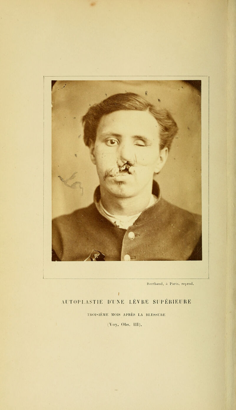 ^T^ ^ Berthand, à Paris, reprod. AUT0PLAST1E DUNE LÈVRE SUPERIEURE TROISIEME MOIS APRES LA BLESSE RE (Voy. Obs. III).