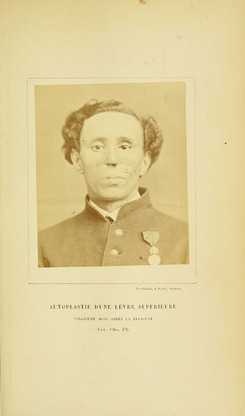 Vv '«^ r ^ 11, nliami. a Palis, it-pii AUTOPLASTIE DUNE LÈVRE SUPERIEURE VINGTIÈME MOIS APRÈS I.A BI>S*l'HK (V'OV, Obs. l!l).