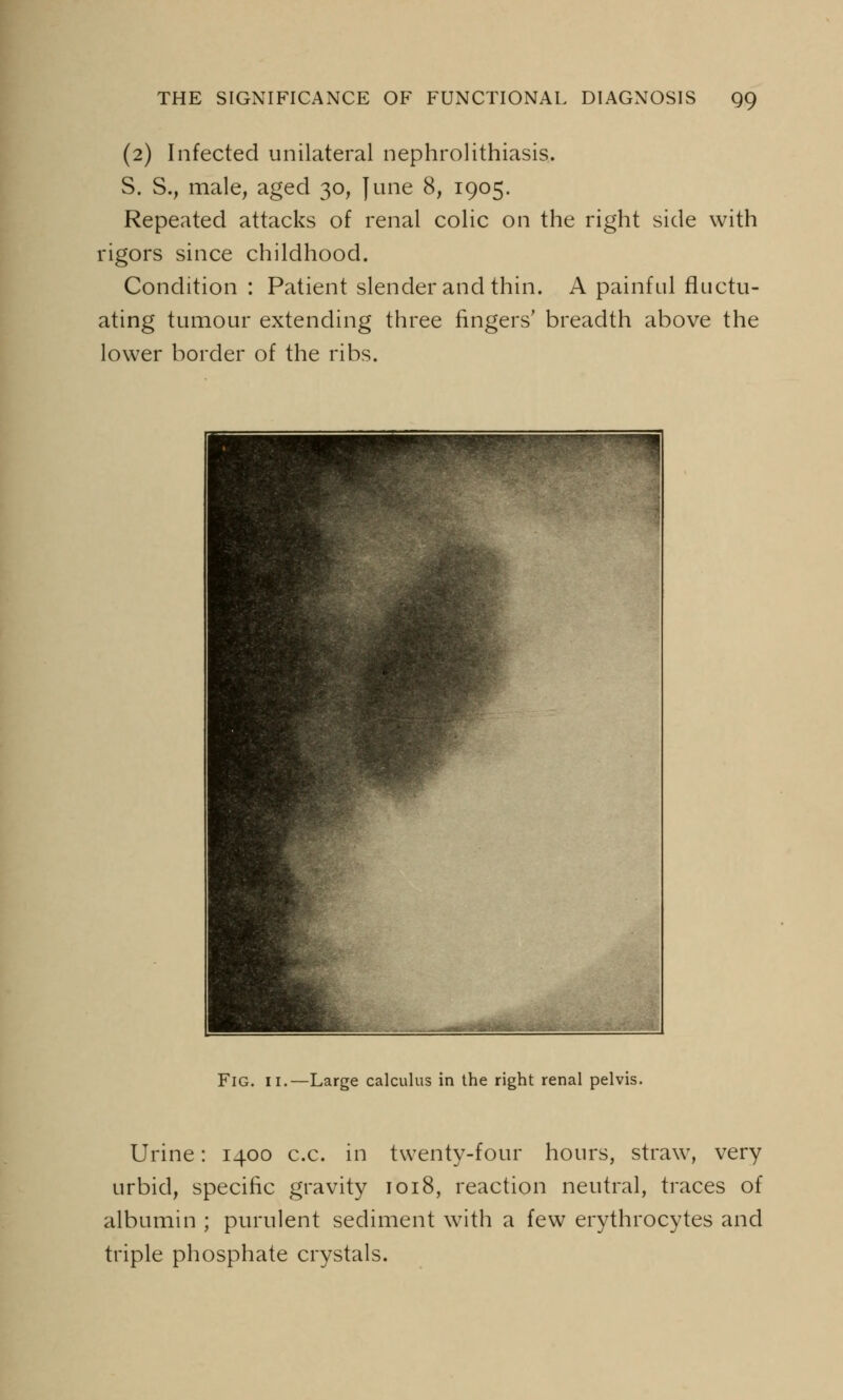 (2) Infected unilateral nephrolithiasis. S. S., male, aged 30, June 8, 1905. Repeated attacks of renal colic on the right side with rigors since childhood. Condition: Patient slender and thin. A painful fluctu- ating tumour extending three ringers' breadth above the lower border of the ribs. Fig. 11.—Large calculus in the right renal pelvis. Urine: 1400 c.c. in twenty-four hours, straw, very urbid, specific gravity 1018, reaction neutral, traces of albumin ; purulent sediment with a few erythrocytes and triple phosphate crystals.