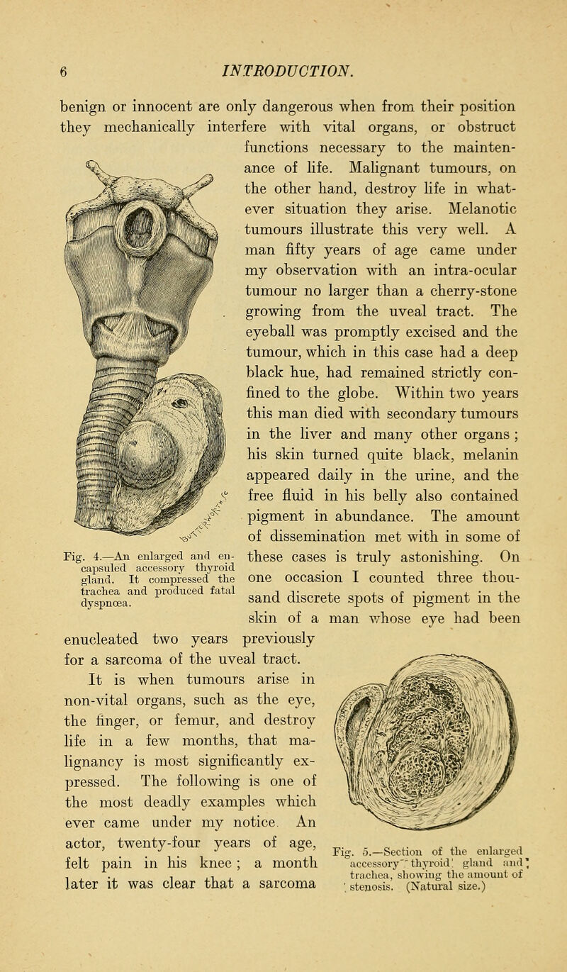 benign or innocent are only dangerous when from their position they mechanically interfere with vital organs, or obstruct functions necessary to the mainten- ance of life. Malignant tumours, on the other hand, destroy life in what- ever situation they arise. Melanotic tumours illustrate this very well. A man fifty years of age came under my observation with an intra-ocular tumour no larger than a cherry-stone growing from the uveal tract. The eyeball was promptly excised and the tumour, which in this case had a deep black hue, had remained strictly con- fined to the globe. Within two years this man died with secondary tumours in the liver and many other organs ; his skin turned quite black, melanin appeared daily in the urine, and the free fluid in his belly also contained pigment in abundance. The amount of dissemination met with in some of Fig. 4.—An enlarged and en- these cascs is truly astonishing. On capsuled accessory thyroid . gland. It compressed the One occasion i counted three thou- d^yspnoea^^ ^^^^ ^^°^ ^ ^ sand discrete spots of pigment in the skin of a man v/hose eye had been enucleated two years previously for a sarcoma of the uveal tract. It is when tumours arise in non-vital organs, such as the eye, the finger, or femur, and destroy life in a few months, that ma- lignancy is most significantly ex- pressed. The following is one of the most deadly examples which ever came under my notice. An actor, twenty-four years of age, ^. . ^ ^. . ., . , . . . Fig. o.—Section of the enlarged felt pain in his knee; a month accessorythyroid' gland and; , , ., T , 1 , trachea, showing the amount of later it was clear that a sarcoma ■ stenosis. (Natural size.)