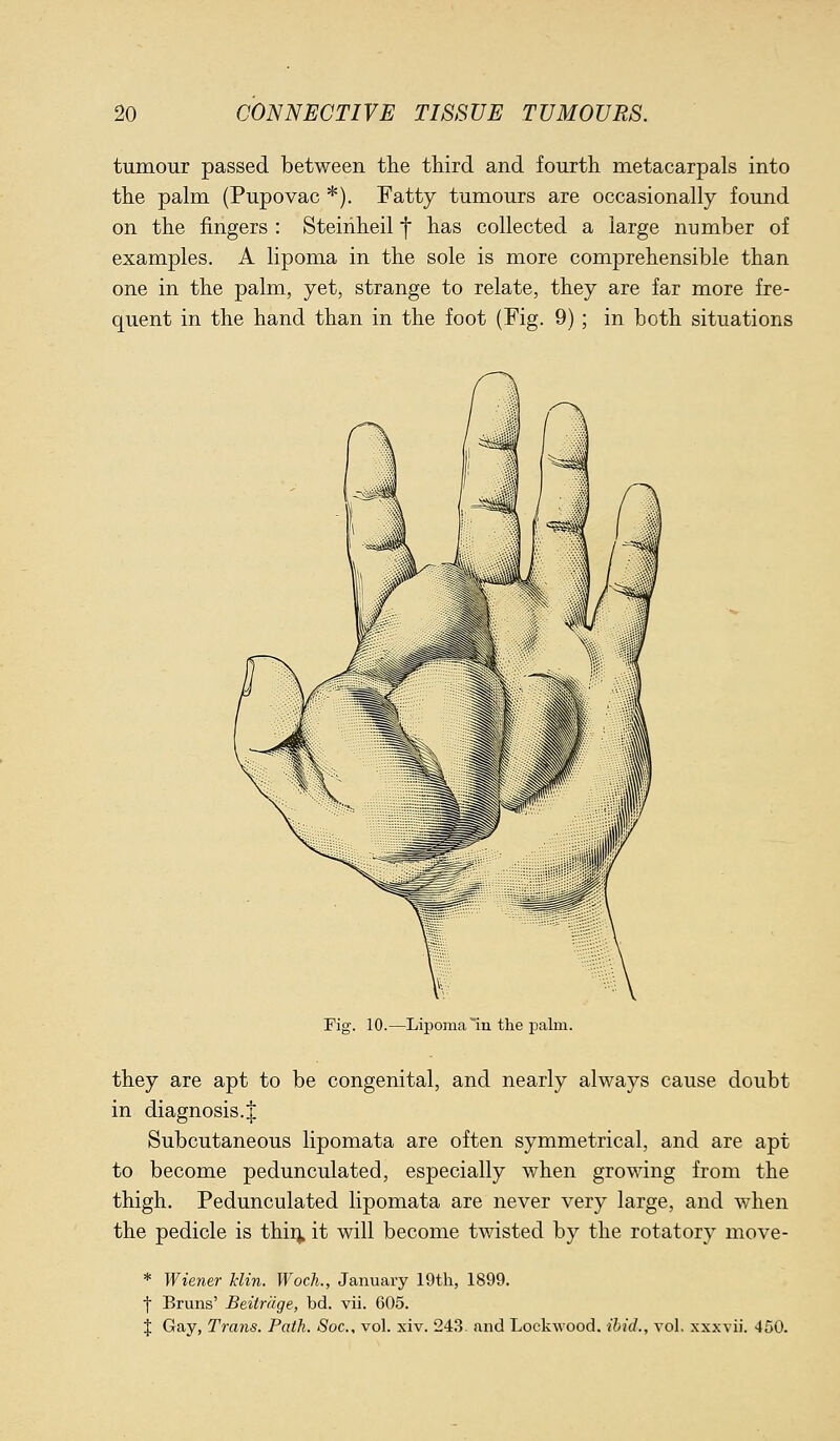 tumour passed between the third and fourth metacarpals into the palm (Pupovac *). Fatty tumours are occasionally found on the fingers : Steiiiheil f has collected a large number of examples. A lipoma in the sole is more comprehensible than one in the palm, yet, strange to relate, they are far more fre- quent in the hand than in the foot (Fig. 9) ; in both situations Fig. 10.—Lipoma in the palm. they are apt to be congenital, and nearly always cause doubt in diagnosis.J Subcutaneous lipomata are often symmetrical, and are apt to become pedunculated, especially when growing from the thigh. Pedunculated lipomata are never very large, and when the pedicle is thii^ it will become twisted by the rotatory move- * Wiener klin. Woch., January 19th, 1899. t Bruns' Beitrdge, bd. vii. 605. % Gay, Trans. Path. Soc, vol. xiv. 24.3. and Lockwood. ibid., vol, xxxvii. 450.