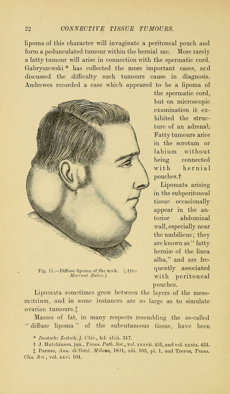 lipoma of this character will invaginate a peritoneal pouch and form a pedunculated tumour within the hernial sac. More rarely a fatty tumour will arise in connection with the spermatic cord. Gabryszewski * has collected the more important cases, and discussed the difficulty such tumours cause in diagnosis. Andrewes recorded a case which appeared to be a lipoma of the spermatic cord, but on microscopic examination it ex- hibited the struc- ture of an adrena); Fatty tumours arise in the scrotum or labium without being connected with hernial pouches.f Lipomata arising in the subperitoneal tissue occasionally appear in the an- terior abdominal wall, especially near the umbihcus; they are known as  fatty herniee of the linea alba, and are fre- quently associated with peritoneal pouches. Lipomata sometimes grow between the layers of the meso- metrium, and in some instances are so large as to simulate ovarian tumours.:}; Masses of fat, in many respects resembling the so-called  diffuse lipoma of the subcutaneous tissue, have been * Deutsche Zeitsch. f. Chir., bd. xlv-ii. 317. t J. Hutchinson, jun., Trans. Path. Soc, vo!. xxxvii. 451, and vol. xxxix. 451. } Parono, Ann. di Ostet. Milano, 18i)l, xiii. 103, pi. 1, and Treves, Trans. Clin. S')c., vol. xxvi. 101. Fig. 11.—Diffuse lipoma of the neck. Iforrant Baker.) {After