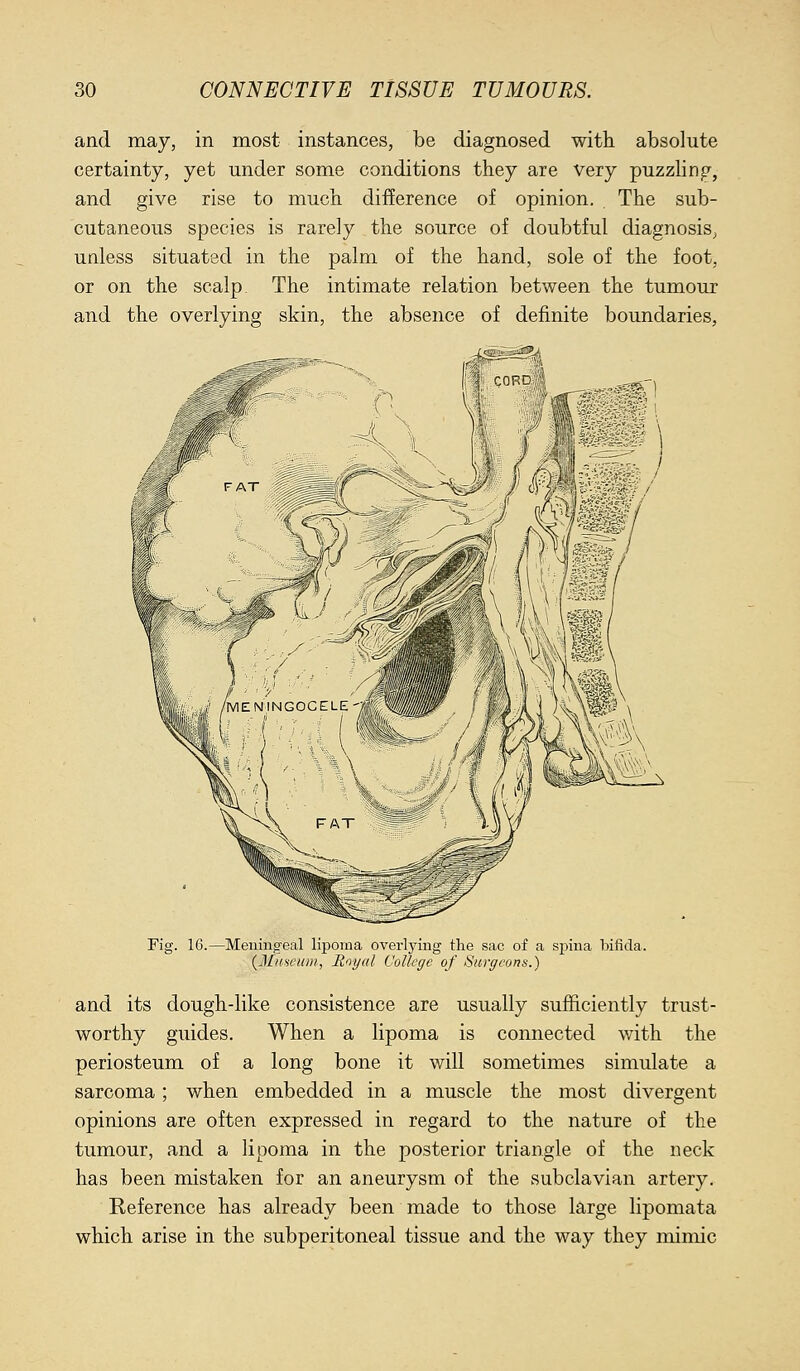 and may, in most instances, be diagnosed with absolute certainty, yet under some conditions they are very puzzHng, and give rise to much difference of opinion. The sub- cutaneous species is rarely the source of doubtful diagnosis^ unless situated in the palm of the hand, sole of the foot, or on the scalp. The intimate relation between the tumour and the overlying skin, the absence of definite boundaries. Fig. 16.—Meningeal lipoma overlying the sac of a sj^ina bifida. {3Iuseuiii, Boynl College of Surgeons.) and its dough-like consistence are usually sufficiently trust- worthy guides. When a lipoma is connected with the periosteum of a long bone it will sometimes simulate a sarcoma; when embedded in a muscle the most divergent opinions are often expressed in regard to the nature of the tumour, and a lipoma in the posterior triangle of the neck has been mistaken for an aneurysm of the subclavian artery. Keference has already been made to those large lipomata which arise in the subperitoneal tissue and the way they mimic