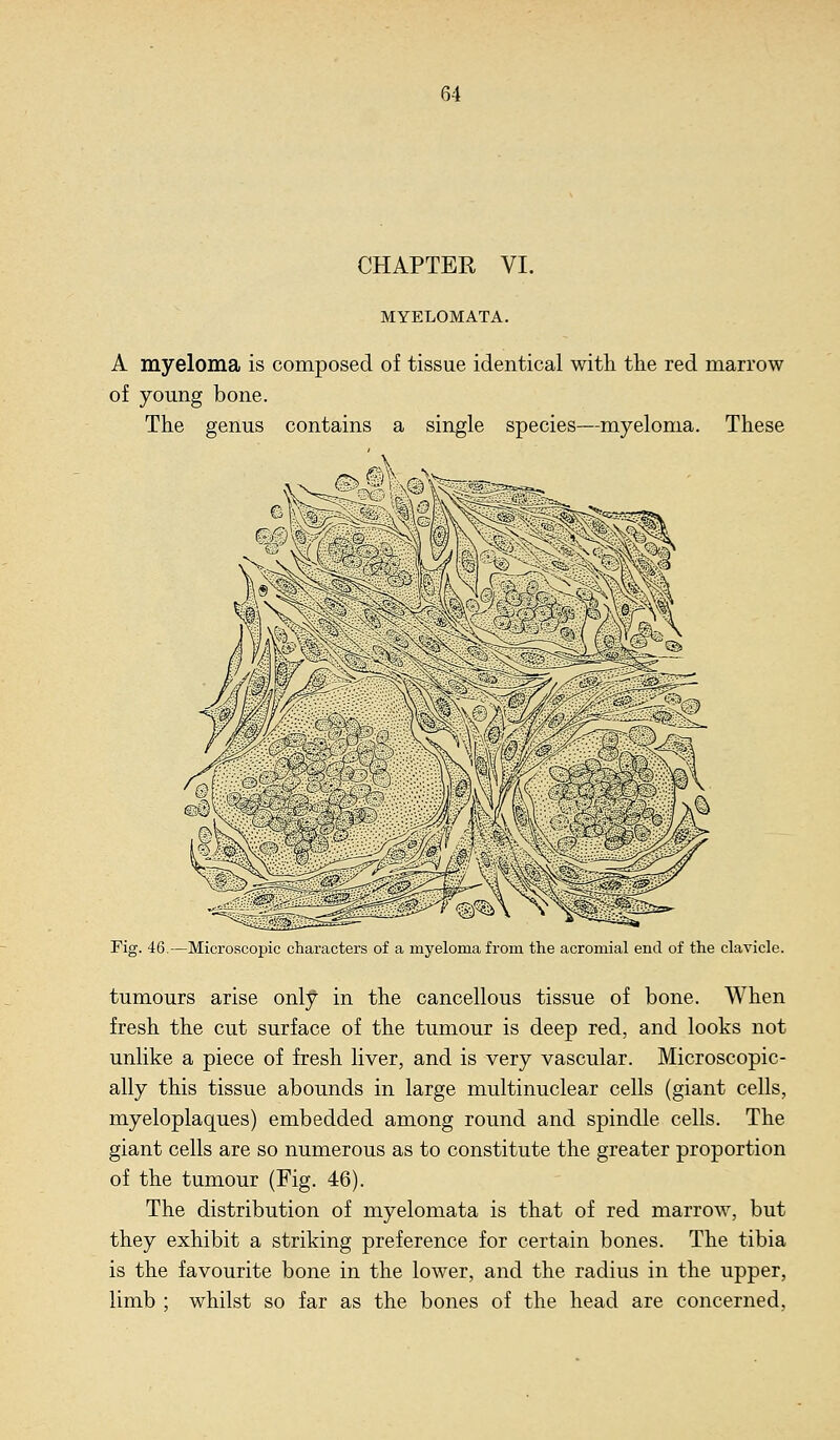 CHAPTER VI. MYELOMATA. A myeloma is composed of tissue identical with the red marrow of young bone. The genus contains a single species—myeloma. These Fig. 46.—Microscopic characters of a myeloma from the acromial end of the clavicle. tumours arise only in the cancellous tissue of bone. When fresh the cut surface of the tumour is deep red, and looks not unlike a piece of fresh liver, and is very vascular. Microscopic- ally this tissue abounds in large multinuclear cells (giant cells, myeloplaques) embedded among round and spindle cells. The giant cells are so numerous as to constitute the greater proportion of the tumour (Fig. 46). The distribution of myelomata is that of red marrow, but they exhibit a striking preference for certain bones. The tibia is the favourite bone in the lower, and the radius in the upper, limb ; whilst so far as the bones of the head are concerned.