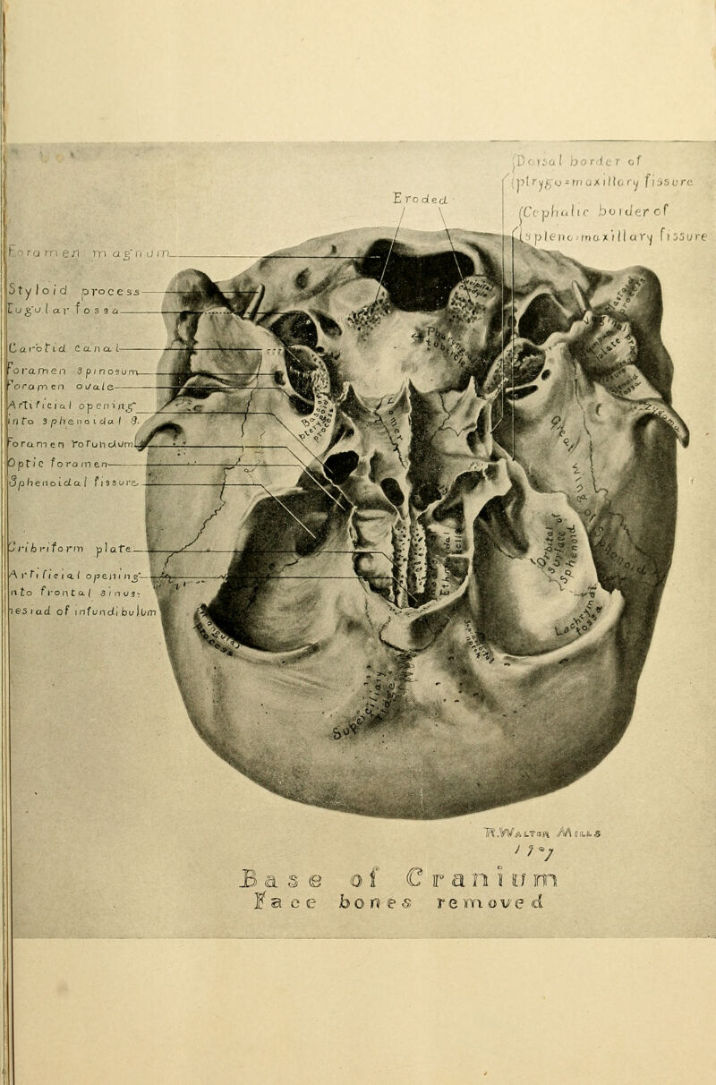 Dcrio I border of Eroded. / \ (ptryg-y-moxillorvy fi5SL're F'^ro rri e Ji rp a p' n u i ri_ Styloid ,o voce S3 Lu ^'u lay Toss a Carotid C a n a. l- 'oi'arnen Spinosun- orapien oi/a/e Artificial opeiiinj; f) fo 3 p /l a n o i d a ( •'?. 'orameo ^orunolum Optic foramen- Sphenoidal fissure 'Jnbrifornt plate — A r Ti fi c I a ( open i nj' ito fi-onta/ sinus- Testad of mfundi bulo B.Wailtsw MiiiLit,s as f C r a n i u inn