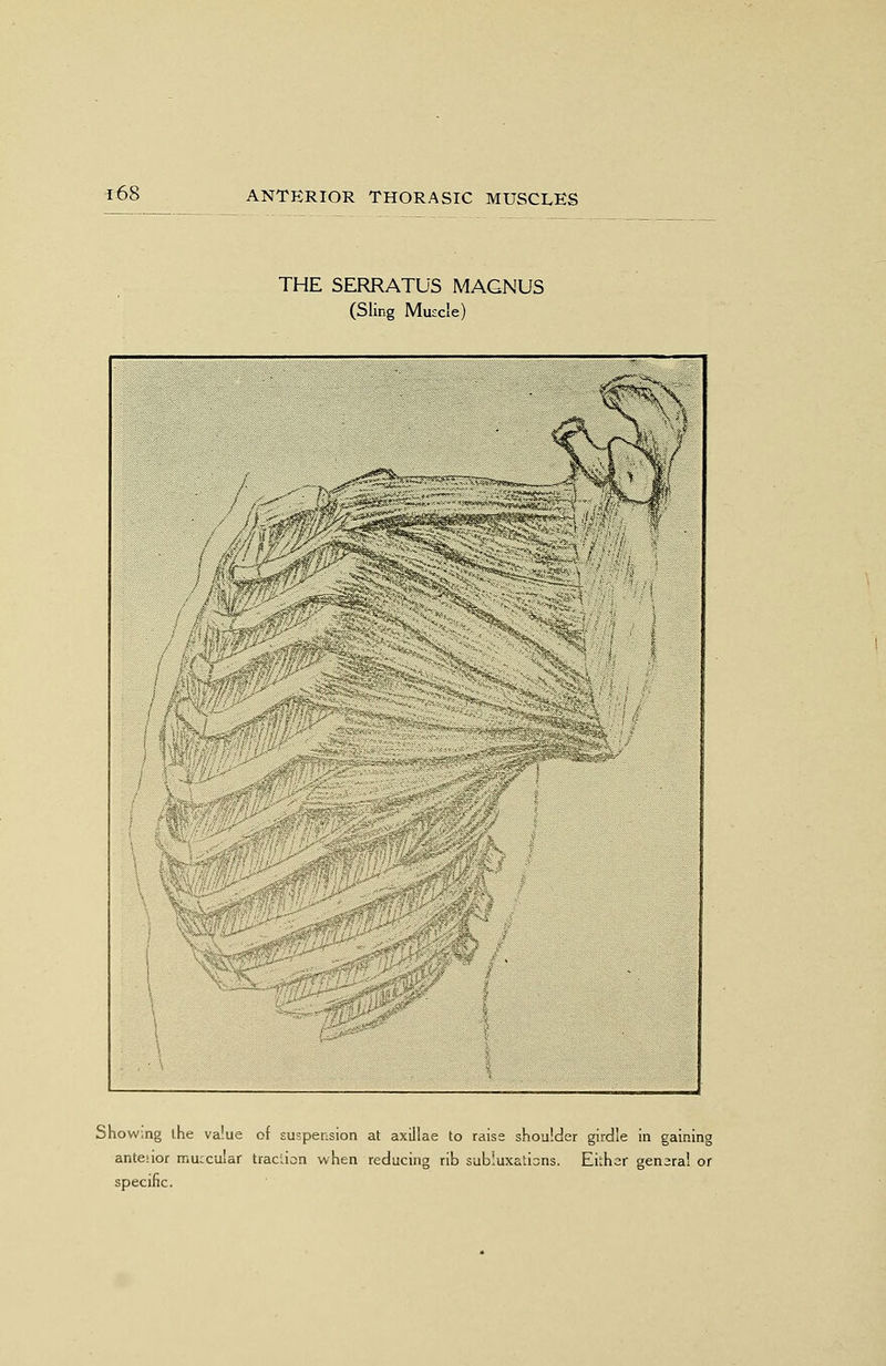 THE SERRATUS MAGNUS (Sling Muscle) Show.ng the value of suspension at axillae to raise shoulder girdle in gaining anteiior muccular traccion when reducing rib subiuxations. Either gensral or specific.