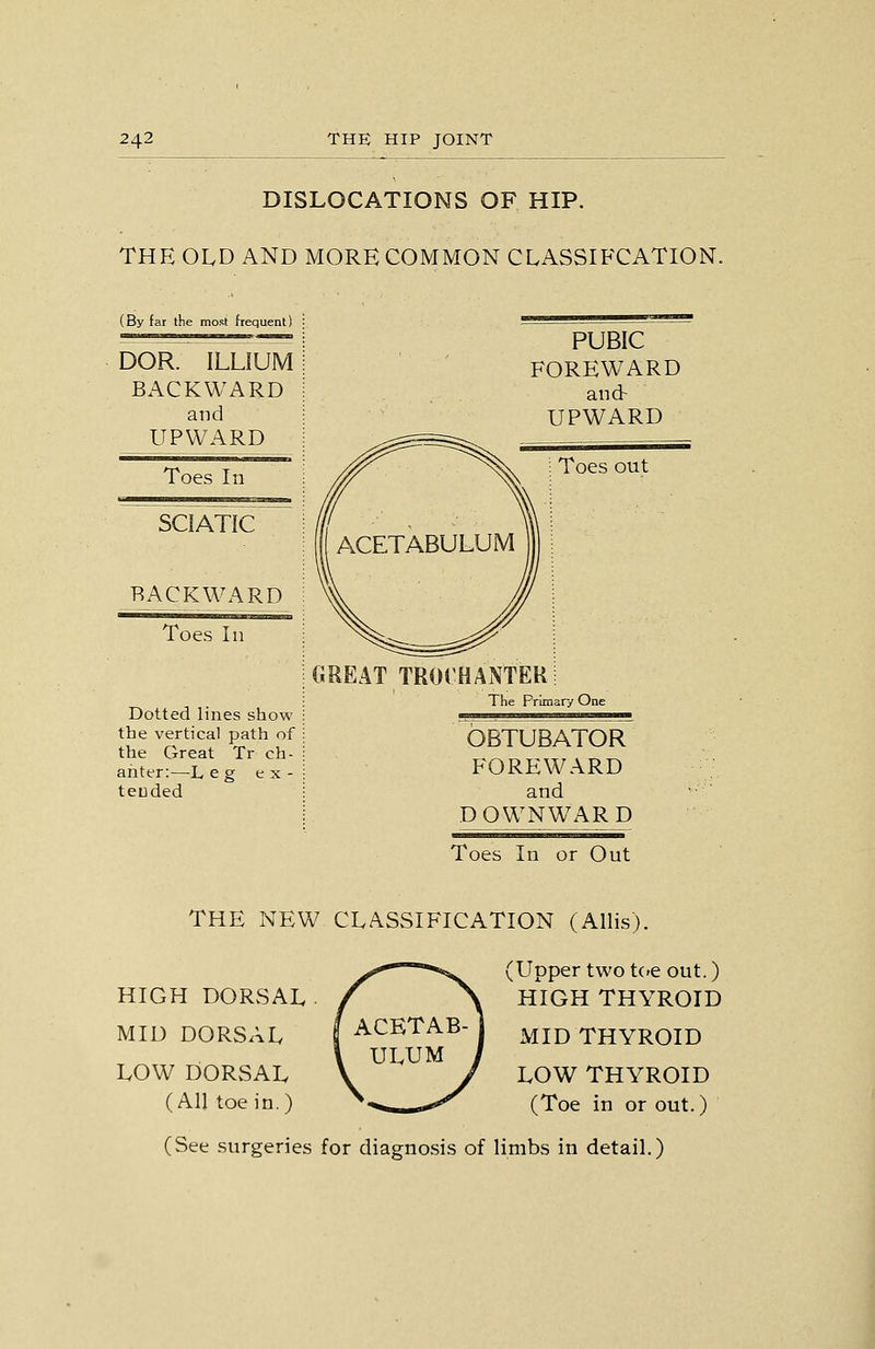 DISLOCATIONS OF HIP. THE OLD AND MORE COMMON CLASSIFCATION. (By far the most frequent) DOR. ILLIUM BACKWARD and UPWARD Toes In SCIATIC BACKWARD Toes In Dotted lines show the vertical path of the Great Tr ch- anter:—L eg e X - tended PUBIC FOREWARD and- UPWARD GREAT TROrHANTER The Primary One obtubatorT FOREWARD and DOWNW^ARD Toes In or Out THE NEW CLASSIFICATION (Allis). HIGH DORSAL MID DORSAL LOW DORSAL (All toe in.) (Upper two t('e out.) HIGH THYROID MID THYROID LOW THYROID (Toe in or out.) (See surgeries for diagnosis of limbs in detail.)