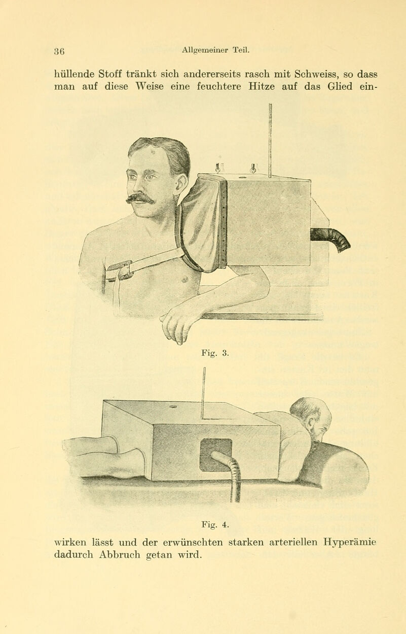 hüllende Stoff tränkt sich andererseits rasch mit Schweiss, so dass man auf diese Weise eine feuchtere Hitze auf das Ghed ein- Fis. 3. Fig. 4. wirken lässt und der erwünschten starken arteriellen Hyperämie dadurch Abbruch getan wird.