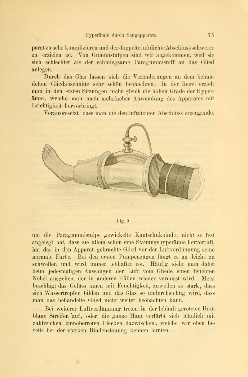 parat zu sehr komplizieren und der doppelte luftdichte Abschluss schwerer zu erzielen ist. Von Gummistulpen sind wir abgekommen, weil sie sich schlechter als der schmiegsame Paragummistoff an das Glied anlegen. Durch das Glas lassen sich die Veränderungen an dem behan- delten Gliedabschnitte sehr schön beobachten. In der Regel erzielt man in den ersten Sitzungen nicht gleich die hohen Grade der Hyper- ämie, welche man nach mehrfacher Anwendung des Apparates mit Leichtigkeit hervorbringt. Vorausgesetzt, dass man die den luftdichten Abschluss erzeugende, Fig, 9. um die Paragummistülpe gewickelte Kautschukbinde, nicht so fest angelegt hat, dass sie allein schon eine Stauungshyperämie hervorruft, hat das in den Apparat gebrachte Glied vor der Luftverdünnung seine normale Farbe. Bei den ersten Pumpenzügen fängt es an leicht zu schwellen und wird immer lebhafter rot. Häufig sieht man dabei beim jedesmaligen Aussaugen der Luft vom Gliede einen feuchten Nebel ausgehen, der in anderen Fällen wieder vermisst wird. Meist beschlägt das Gefäss innen mit Feuchtigkeit, zuweilen so stark, dass sich Wassertropfen bilden und das Glas so undurchsichtig wird, dass man das behandelte Glied nicht weiter beobachten kann. Bei weiterer Luftverdünnung treten in der lebhaft geröteten Haut blaue Streifen auf, oder die ganze Haut verfärbt sich bläulich mit zahlreichen zinnoberroten Flecken dazwischen, welche wir oben be- reits bei der starken Bindenstauung kennen lernten.