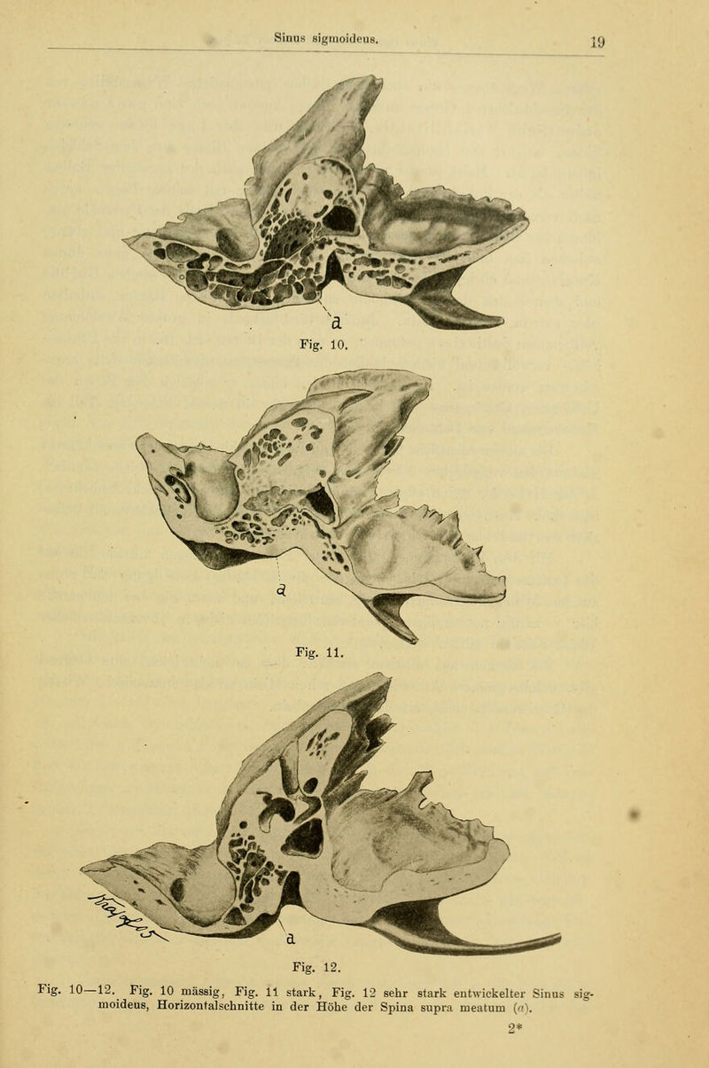 Sinus sigmoideus. Fig. 11. Fig. 12. Fig. 10—12.^ Fig. 10 massig, Fig. 11 stark, Fig. 12 sehr stark entwickelter Sinus sig- moideus, Horizontalschnitte in der Höhe der Spina supra meatum (o). 2*