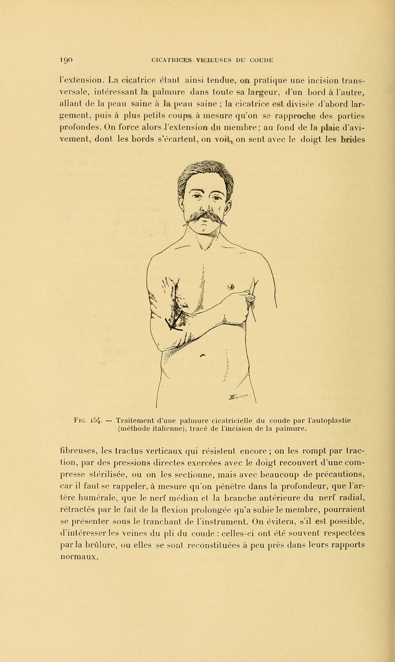 l'extension. La cicatrice (Haut ainsi tendue, on pratique une incision trans- versale, intéressant la palmure dans toute sa largeur, d'un bord à l'autre, allant de la peau saine à la peau saine ; la cicatrice est divisée d'abord lar- gement, puis à plus petits coups à mesure qu'on se rapproche des parties profondes. On force alors l'extension du membre; au fond de la plaie d'avi- vement, dont les bords s'écarteul, on voit, on sent avec le doigt les brides Fie. 154. Traitement d'une palmure cicatricielle du coude par l'autoplastie (méthode italienne), tracé de l'incision de la palmure. fibreuses, les tractus verticaux qui résistent encore ; on les rompt par trac- tion, par des pressions directes exercées avec le doigt recouvert d'une com- presse stérilisée, ou on les sectionne, mais avec beaucoup de précautions, car il faut se rappeler, à mesure qu'on pénètre dans la profondeur, que l'ar- tère numérale, que le nerf médian et la branche antérieure du nerf radial, rétractés par le fait de la flexion prolongée qu'a subie le membre, pourraient se présenter sous le tranchant de l'instrument. On évitera, s'il est possible, d'intéresser les veines du pli du coude : celles-ci ont été souvent respectées par la brûlure, ou elles se sont reconstituées à peu près dans leurs rapports normaux.