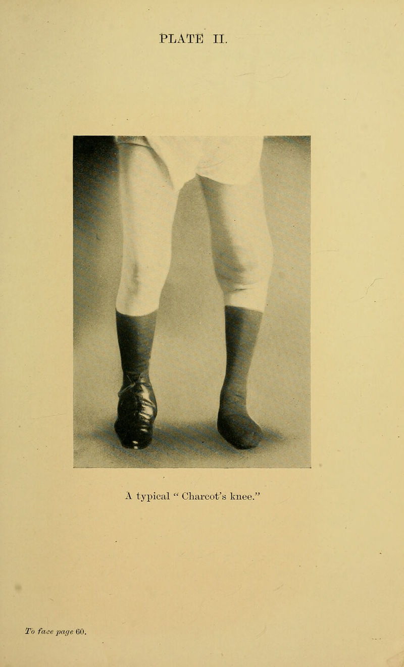 A typical  Charcot's knee. To face page \