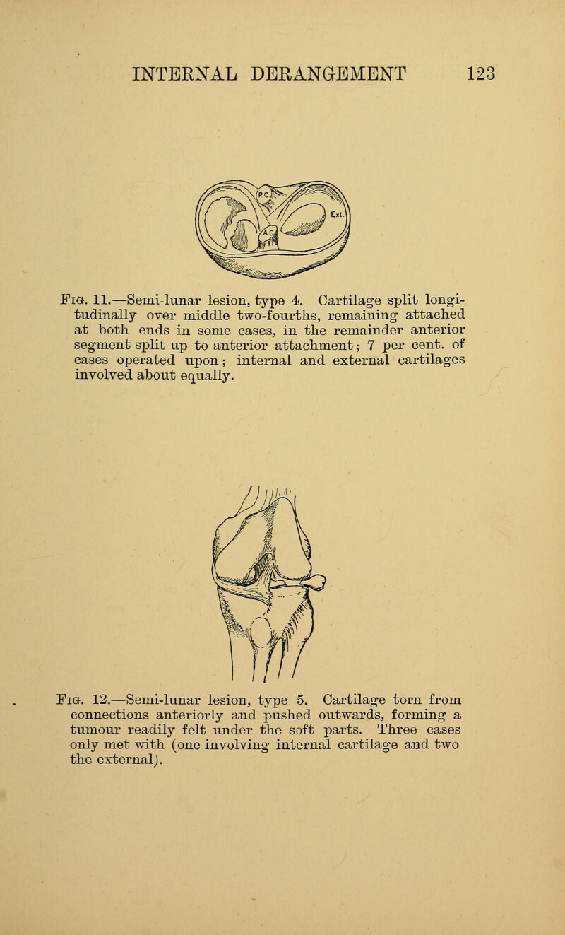 Fig. 11.—Semi-lunar lesion, type 4. Cartilage split longi- tudinally over middle two-fourths, remaining attached at both ends in some cases, in the remainder anterior segment split up to anterior attachment; 7 per cent, of cases operated upon; internal and external cartilages involved about equally. Fig. 12.—Semi-lunar lesion, type 5. Cartilage torn from connections anteriorly and pushed outwards, forming a tumour readily felt under the soft parts. Three cases only met with (one involving internal cartilage and two the external).