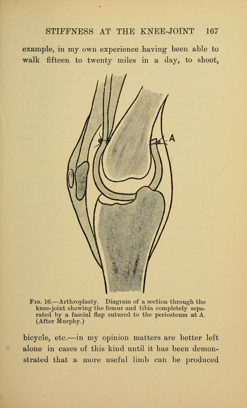 example, in my own experience having been able to walk fifteen to twenty miles in a day, to shoot, Fig. 16.—Arthroplasty. Diagram of a section througli the knee-joint showing the femnr and tibia completely sepa- rated by a fascial flap siitnred to the periosteum at A. (After Murphy.) bicycle, etc.—in my opinion matters are better left alone in cases of this kind until it has been demon- strated that a more useful limb can be produced