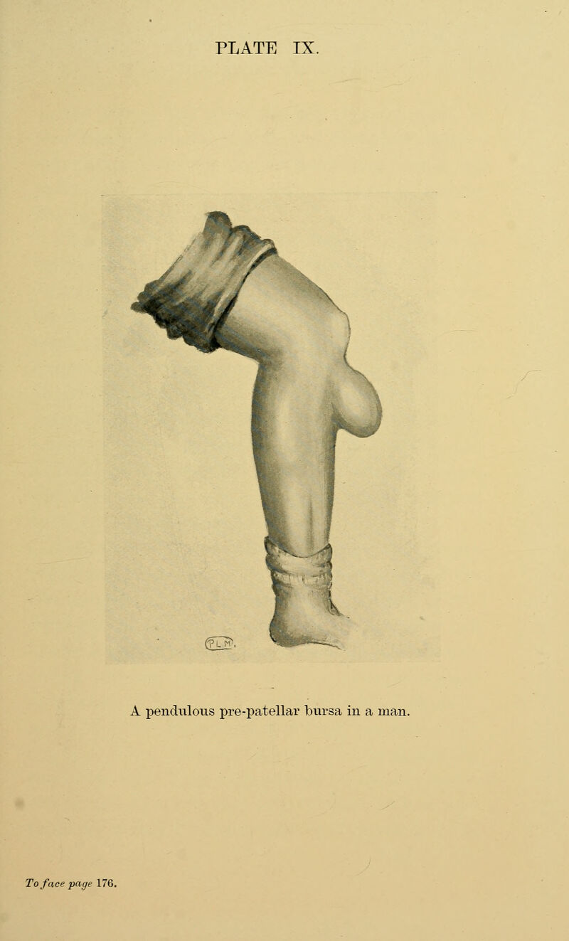 A pendulous pre-patellar bursa in a man. To face page 176.