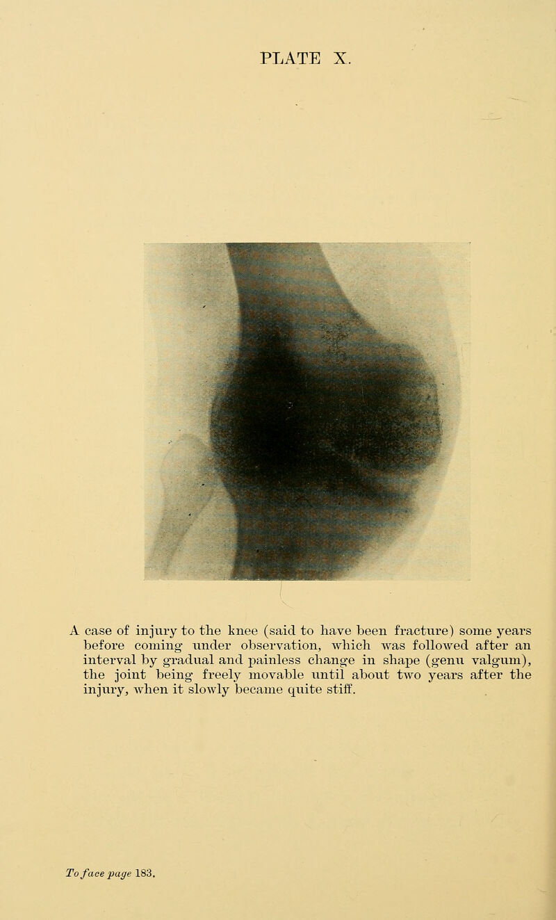 A case of injury to the knee (said to liave been fracture) some years before coming- under observation, which was followed after an interval by gradual and painless change in shape (genu valgvim), the joint being freely movable until about two years after the injury, when it slowly became quite stiff.
