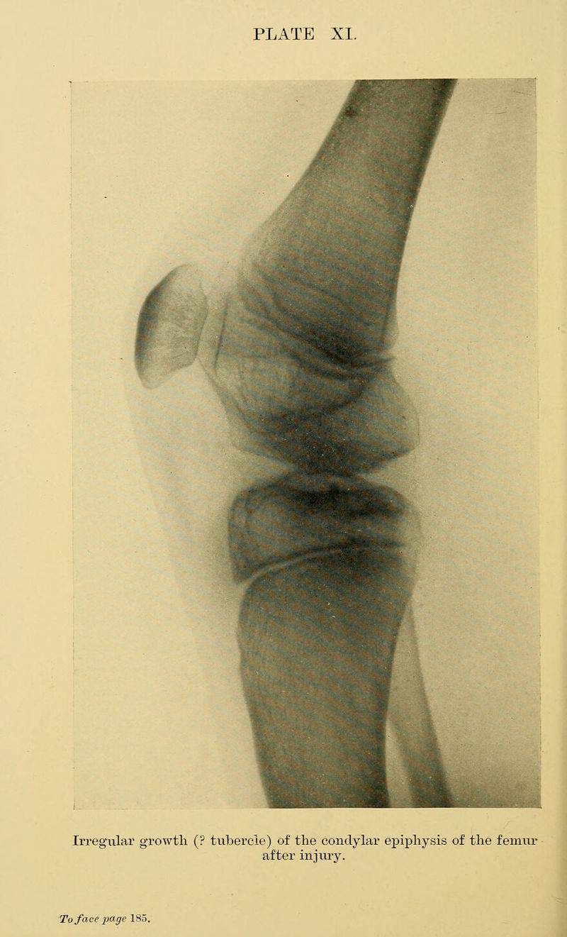 ^ Irregular growtli (? tvibercle) of the condylar epiphysis of the femur after injury. i