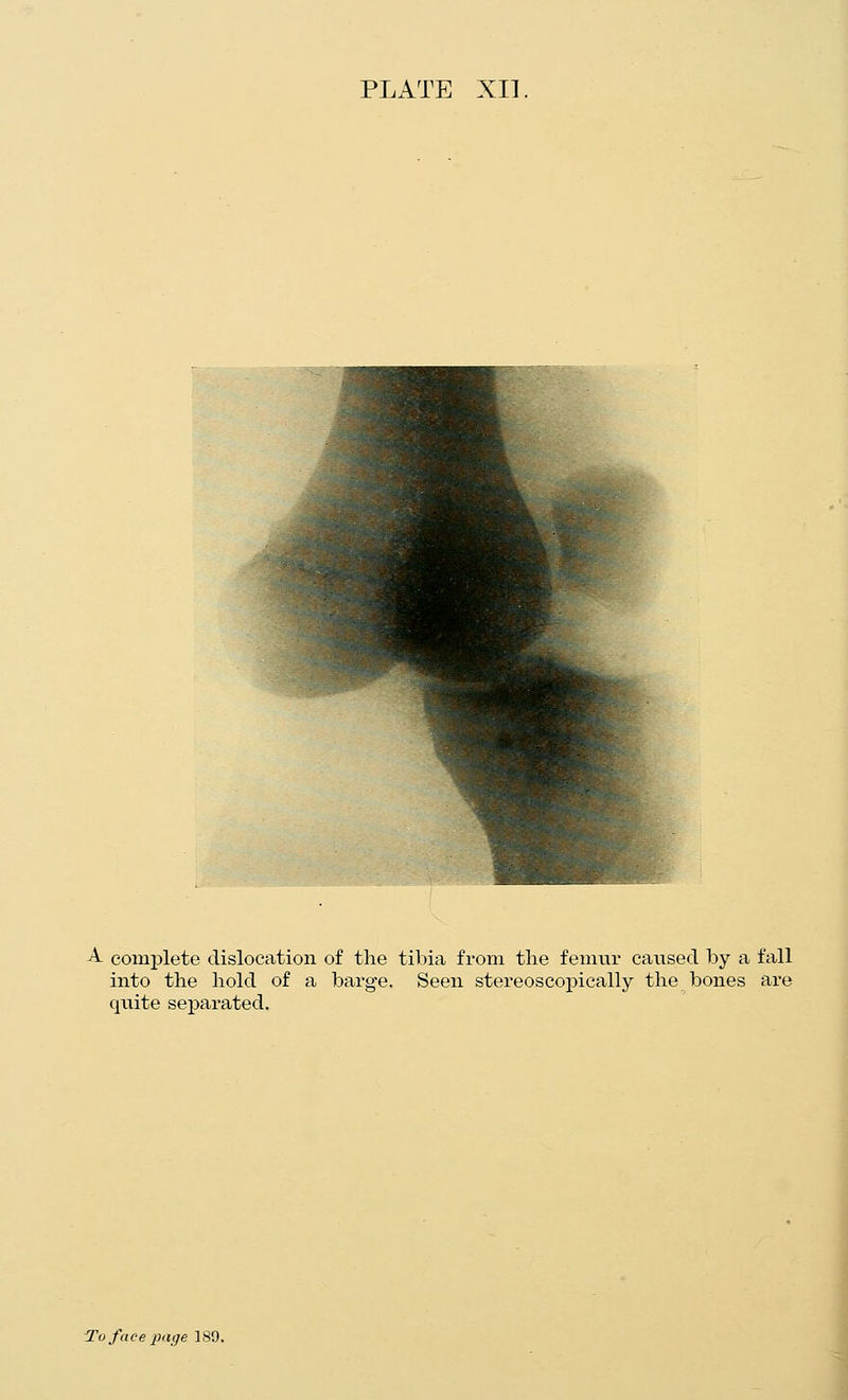 A complete dislocation of the tibia from the femur caused by a fall into the hold of a barge. Seen stereoscox)ically the bones are quite separated.