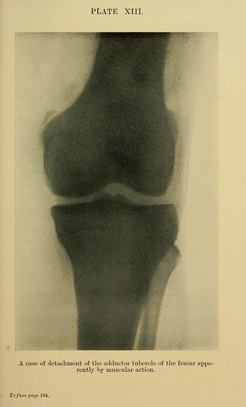 PLATE XIII. A case of detachment of the adductor tiibercle of the femur appa- rently by musciilar action. To face page 194.