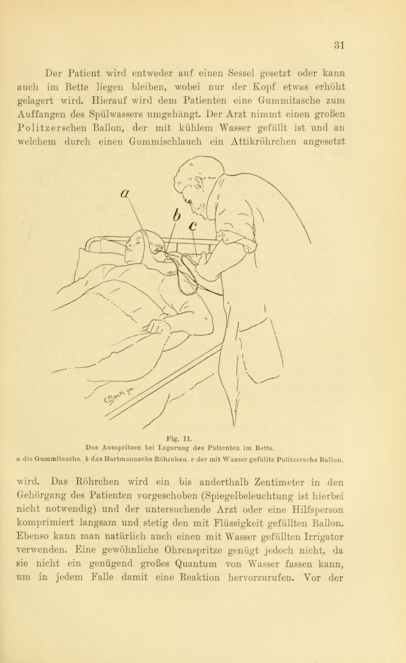 Der Patient wird entweder auf einen Sessel gesetzt oder kann auch im Bette liegen bleiben, wobei nur der Kopf etwas erhöht gelagert wird. Hierauf wird dem Patienten eine Gummitasche zum Auffangen des Spülwassers umgehängt. Der Arzt nimmt einen großen Politzersehen Ballon, der mit kühlem Wasser gefüllt ist und an welchem durch einen Gummischlauch ein Attikröhrchen angesetzt Fig. 11. Das Ausspritzen bei Lagerung des Patienten im Bette. u die Gummitasche, b das Hartmannsche Röhrchen. c der mit Wasser gefüllte Politzersche Ballon. wird. Das Köhrchen wird ein bis anderthalb Zentimeter in den Gehörgang des Patienten vorgeschoben (Spiegelbeleuchtung ist hierbei nicht notwendig) und der untersuchende Arzt oder eine Hilfsperson komprimiert langsam und stetig den mit Flüssigkeit gefüllten Ballon. Ebenso kann man natürlich auch einen mit Wasser gefüllten Irrigator verwenden. Eine gewöhnliche Ohrenspritze genügt jedoch nicht, da sie nicht ein genügend großes Quantum von Wasser fassen kann, um in jedem Falle damit eine Reaktion hervorzurufen. Vor der