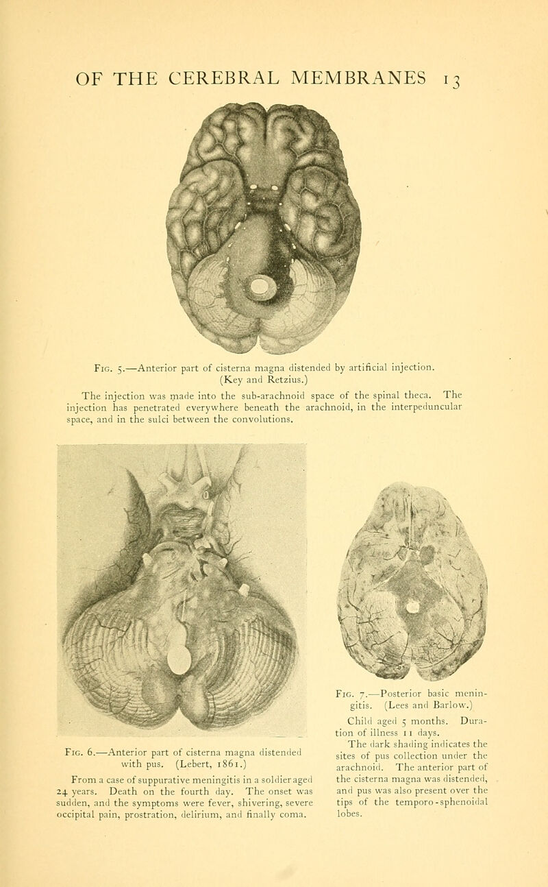 Fig. 5.—Anterior part of cisterna magna distended by artificial injection. (Key and Retzius.) The injection was made into the sub-arachnoid space of the spinal theca. The injection has penetrated everywhere beneath the arachnoid, in the interpeduncular space, and in the sulci between the convolutions. Fig. 5.—Anterior part of cisterna magna distended with pus. (Lebert, i85i.) From a case of suppurative meningitis in a soldier aged 24 years. Death on the fourth day. The onset was sudden, and the symptoms were fever, shivering, severe occipital pain, prostration, delirium, and finally coma. Fig. 7.—Posterior basic menin- gitis. (Lees and Barlow.) Child aged 5 months. Dura- tion of illness 11 days. The dark shading indicates the sites of pus collection under the arachnoid. The anterior part of the cisterna magna was distended, and pus was also present over the tips of the temporo-sphenoidal lobes.