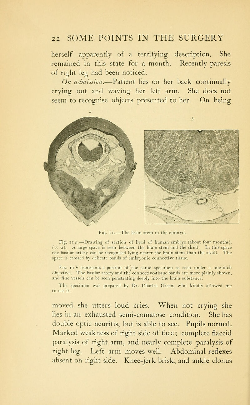 herself apparently of a terrifying description. She remained in this state for a month. Recently paresis of right leg had been noticed. On admission.—Patient lies on her back continually crying out and waving her left arm. She does not seem to recognise objects presented to her. On being J .^^' Fig. II.—The brain stem in the embryo. Fig. 11 a.—Drawing of section of head of human embryo (about four months). ( X 2). A large space is seen between the brain stem and the skull. In this space the basilar artery can be recognised lying nearer the brain stem than the skull. The space is crossed by delicate bands of embryonic connective tissue. Fig. lib represents a portion of the same specimen as seen under a one-inch objective. The basilar artery and the connective-tissue bands are more plainly shown, and fine vessels can be seen penetrating deeply into the brain substance. The specimen was prepared by Dr. Charles Green, who kindly allowed me to use it. moved she utters loud cries. When not crying she lies in an exhausted semi-comatose condition. She has double optic neuritis, but is able to see. Pupils normal. Marked weakness of right side of face; complete flaccid paralysis of right arm, and nearly complete paralysis of right leg. Left arm moves well. Abdominal reflexes absent on right side. Knee-jerk brisk, and ankle clonus