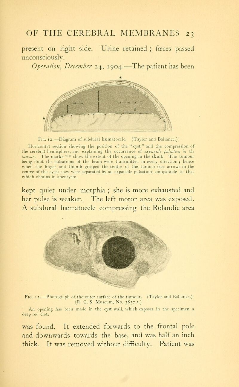 present on right side. Urine retained ; fasces passed unconsciously. Operation, December 24, 1904.-—^The patient has been Fig. 12.—Diagram of subdural haematocele. (Taylor and Ballance.) Horizontal section showing the position of the  cyst  and the compression of the cerebral hemisphere, and explaining the occurrence of expansile pulsation in the tumour. The marks * * show the extent of the opening in the skull. The tumour being fluid, the pulsations of the brain were transmitted in every direction ; hence when the finger and thumb grasped the centre of the tumour (see arrows in the centre of the cyst) they were separated by an expansile pulsation comparable to that which obtains in aneurysm. kept quiet under morphia ; she is more exhausted and her pulse is weaker. The left motor area was exposed. A subdural hasmatocele compressing the Rolandic area Fig. 13.—Photograph of the outer surface of the tumour. (Taylor and Ballance.) (R. C. S. Museum, No. 3837 a.) An opening has been made in the cyst wall, which exposes in the specimen a deep red clot. was found. It extended forwards to the frontal pole and downwards towards the base, and was half an inch thick. It was removed without difficulty. Patient was