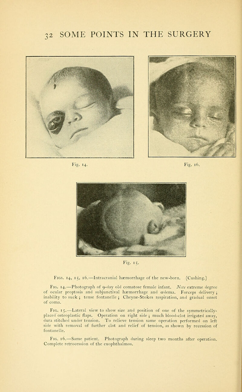 Fig. i+. Fig. i( Fig. U. Figs. 14, 15, 16.—Intracranial haemorrhage of the new-born. (Gushing.) Fig. 14.—Photograph of 9-day old comatose female infant. Note extreme degree of ocular proptosis and subjunctival haemorrhage and cedema. Forceps delivery ; inability to suck ; tense fontanelle ; Cheyne-Stokes respiration, and gradual onset of coma. Fig. 15.—Lateral view to show size and position of one of the symmetrically- placed osteoplastic flaps. Operation on right side ; much blood-clot irrigated away, dura stitched under tension. To relieve tension same operation performed on left side with removal of further clot and relief of tension, as shown by recession of fontanelle. Fig. 16.—Same patient. Photograph during sleep two months after operation. Complete retrocession of the exophthalmos.