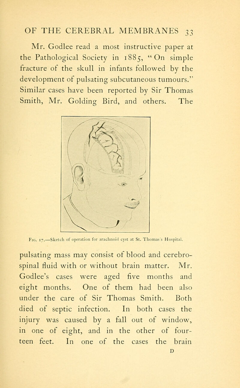 Mr. Godlee read a most instructive paper at the Pathological Society in 1885, On simple fracture of the skull in infants followed by the development of pulsating subcutaneous tumours. Similar cases have been reported by Sir Thomas Smith, Mr. Golding Bird, and others. The Fig. 17.—Sketch of operation for arachnoid cyst at St. Thomas's Hospital. pulsating mass may consist of blood and cerebro- spinal fluid with or without brain matter. Mr. Godlee's cases were aged five months and eight months. One of them had been also under the care of Sir Thomas Smith. Both died of septic infection. In both cases the injury was caused by a fall out of window, in one of eight, and in the other of four- teen feet. In one of the cases the brain D