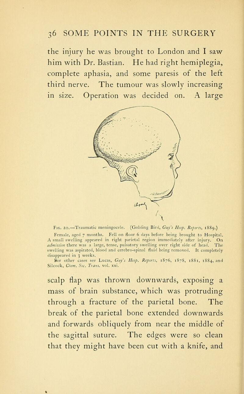 the injury he was brought to London and I saw him with Dr. Bastian. He had right hemiplegia, complete aphasia, and some paresis of the left third nerve. The tumour was slowly increasing in size. Operation was decided on. A large Fig. 20.—Traumatic meningocele. (Golding Bird, Guy'i Hasp. Reports, 1889.) Female, aged 7 months. Fell on floor 6 days before being brought to Hospital. A small swelling appeared in right parietal region immediately after injury. On admission there was a large, tense, pulsatory swelling over right side of head. The swelling was aspirated, blood and cerebro-spinal fluid being removed. It completely- disappeared in 3 weeks. Bior other cases see Lucas, Guy's Hosp. Reports, 1876, 1878, 1881, 1884, and Silcock, C/iem. Soc. Trans, vol. xxi. scalp flap was thrown downwards, exposing a mass of brain substance, which was protruding through a fracture of the parietal bone. The break of the parietal bone extended downwards and forwards obliquely from near the middle of the sagittal suture. The edges were so clean that they might have been cut with a knife, and