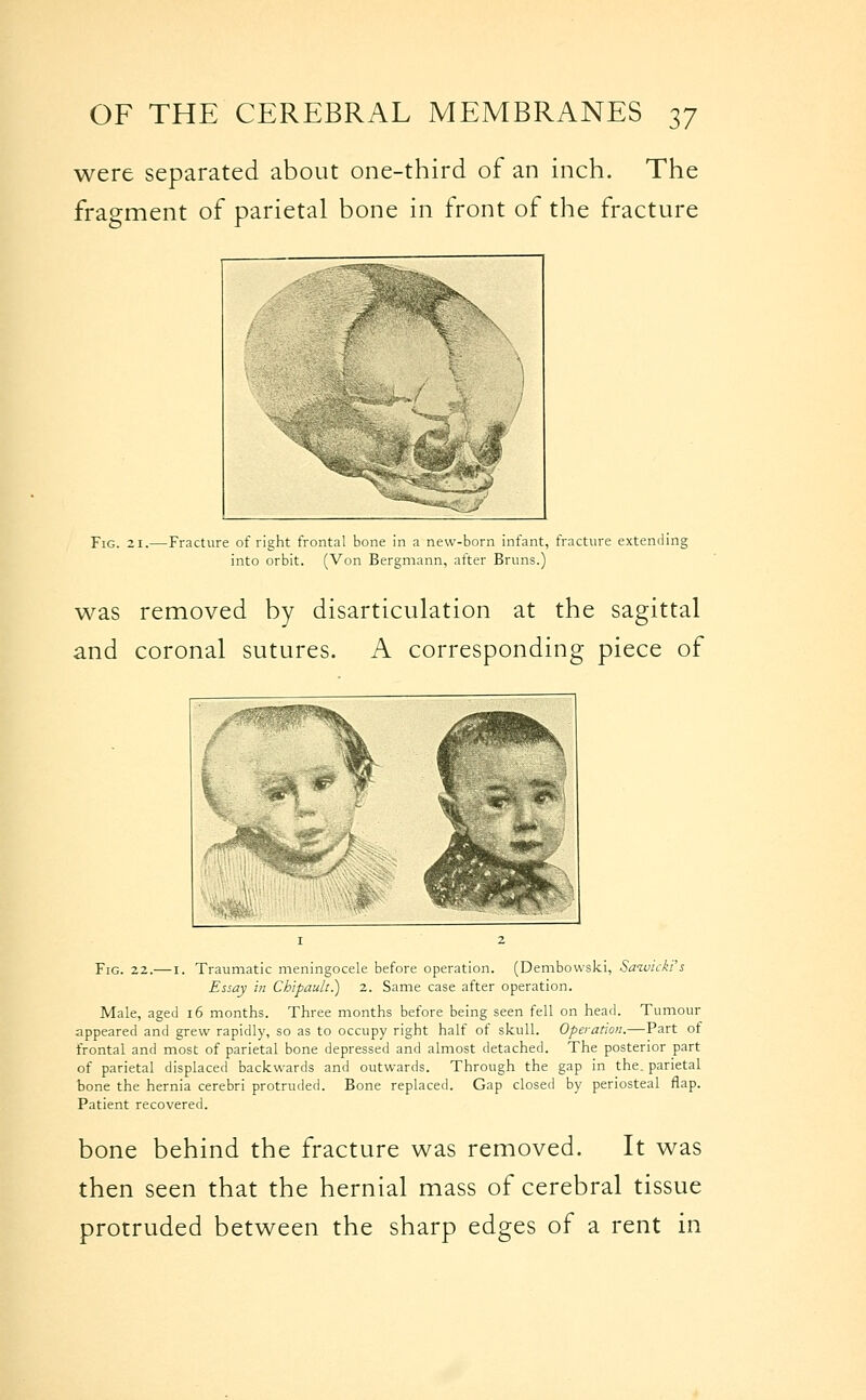 were separated about one-third of an inch. The fragment of parietal bone in front of the fracture -^^IS Fig. 21.—Fracture of right frontal bone in a new-born infant, fracture extending into orbit. (Von Bergmann, after Bruns.) was removed by disarticulation at the sagittal and coronal sutures. A corresponding piece of Fig. 22.— I. Traumatic meningocele before operation. (Dembowski, Saivicki's Essay in Chipault.) z. Same case after operation. Male, aged i6 months. Three months before being seen fell on head. Tumour appeared and grew rapidly, so as to occupy right half of skull. Operation.—Part of frontal and most of parietal bone depressed and almost detached. The posterior part of parietal displaced backwards and outwards. Through the gap in the. parietal bone the hernia cerebri protruded. Bone replaced. Gap closed by periosteal flap. Patient recovered. bone behind the fracture was removed. It was then seen that the hernial mass of cerebral tissue protruded between the sharp edges of a rent in