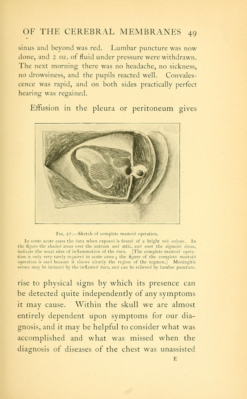 sinus and beyond was red. Lumbar puncture was now done, and 2 oz. of fluid under pressure were withdrawn. The next morning there was no headache, no sickness, no drowsiness, and the pupils reacted well. Convales- cence was rapid, and on both sides practically perfect hearing was regained. Elusion in the pleura or peritoneum gives Fig. 27.—sketch of complete mastoid operation. In some acute cases tlie dura when exposed is found of a bright red colour. In the figure the shaded areas over the antrum and attic, and over the sigmoid sinus, indicate the usual sites of inflammation of the dura. (The complete mastoid opera- tion is only very rarely required in acute cases ; the figure of the complete mastoid operation is used because it shows clearly the region of the tegmen.) Meningitis serosa may be induced by the inflamed dura, and can be relieved by lumbar puncture. rise to physical signs by which its presence can be detected quite independently of any symptoms it may cause. Within the skull we are almost entirely dependent upon symptoms for our dia- gnosis, and it may be helpful to consider what was accomplished and what was missed when the diagnosis of diseases of the chest was unassisted