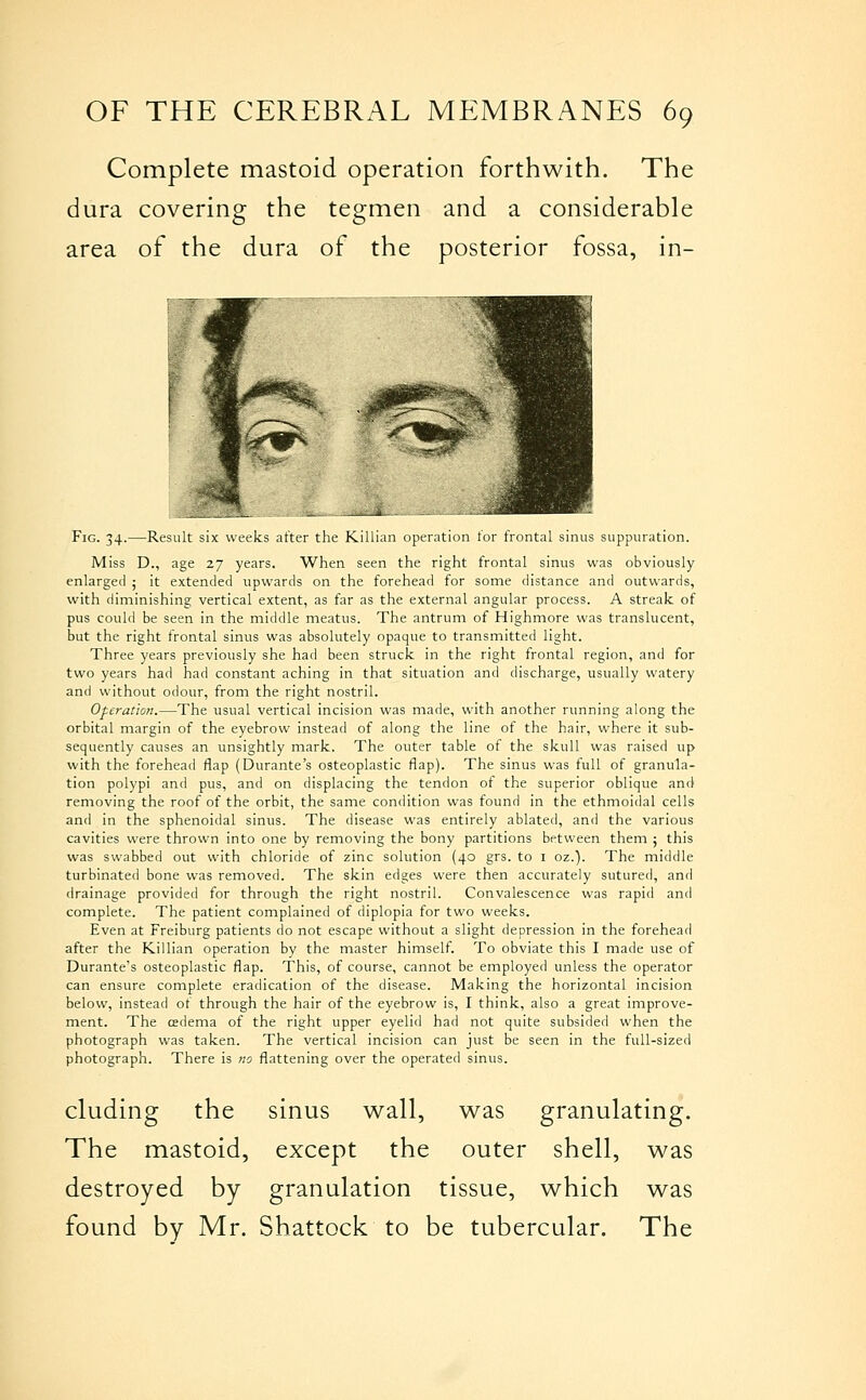 Complete mastoid operation forthwith. The dura covering the tegmen and a considerable area of the dura of the posterior fossa, in- FiG. 34.—Result six weeks after the K.1I11.111 operation tor frontal sinus suppuration. Miss D., age 27 years. When seen the right frontal sinus was obviously enlarged ; it extended upwards on the forehead for some distance and outwards, with diminishing vertical extent, as far as the external angular process. A streak of pus could be seen in the middle meatus. The antrum of Highmore was translucent, but the right frontal sinus was absolutely opaque to transmitted light. Three years previously she had been struck in the right frontal region, and for two years had had constant aching in that situation and discharge, usually watery and without odour, from the right nostril. Operation.—The usual vertical incision was made, with another running along the orbital margin of the eyebrow instead of along the line of the hair, where it sub- sequently causes an unsightly mark. The outer table of the skull was raised up with the forehead flap (Durante's osteoplastic flap). The sinus was full of granula- tion polypi and pus, and on displacing the tendon of the superior oblique and removing the roof of the orbit, the same condition was found in the ethmoidal cells and in the sphenoidal sinus. The disease was entirely ablated, and the various cavities were thrown into one by removing the bony partitions between them 5 this was swabbed out with chloride of zinc solution (40 grs. to i oz.). The middle turbinated bone was removed. The skin edges were then accurately sutured, and drainage provided for through the right nostril. Convalescence was rapid and complete. The patient complained of diplopia for two weeks. Even at Freiburg patients do not escape without a slight depression in the forehead after the Killian operation by the master himself. To obviate this I made use of Durante's osteoplastic flap. This, of course, cannot be employed unless the operator can ensure complete eradication of the disease. Making the horizontal incision below, instead of through the hair of the eyebrow is, I think, also a great improve- ment. The cedema of the right upper eyelid had not quite subsided when the photograph was taken. The vertical incision can just be seen in the full-sized photograph. There is no flattening over the operated sinus. eluding the The mastoid. sinus wall, was granulating. except the outer shell, was destroyed by granulation tissue, which was found by Mr. Shattock to be tubercular. The