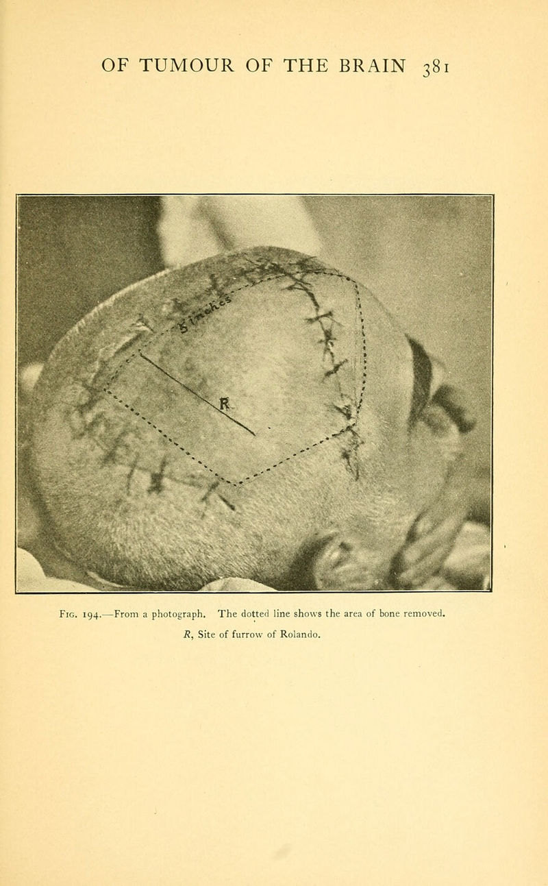Fig. 194.—From a photograph. The dotted line shows the area of bone removed. R, Site of furrow of Rolando.