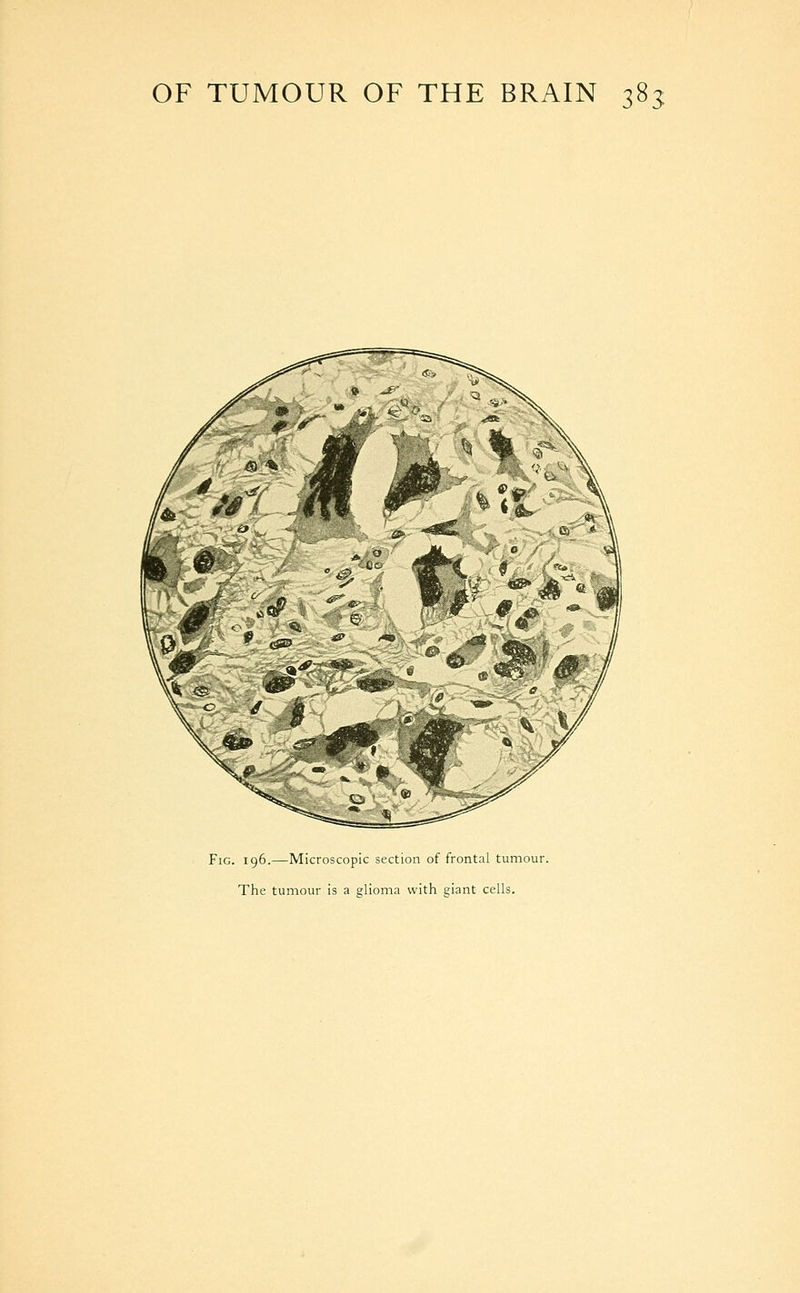 Fig. 196.—Microscopic section of frontal tumour. The tumour is a glioma with giant cells.