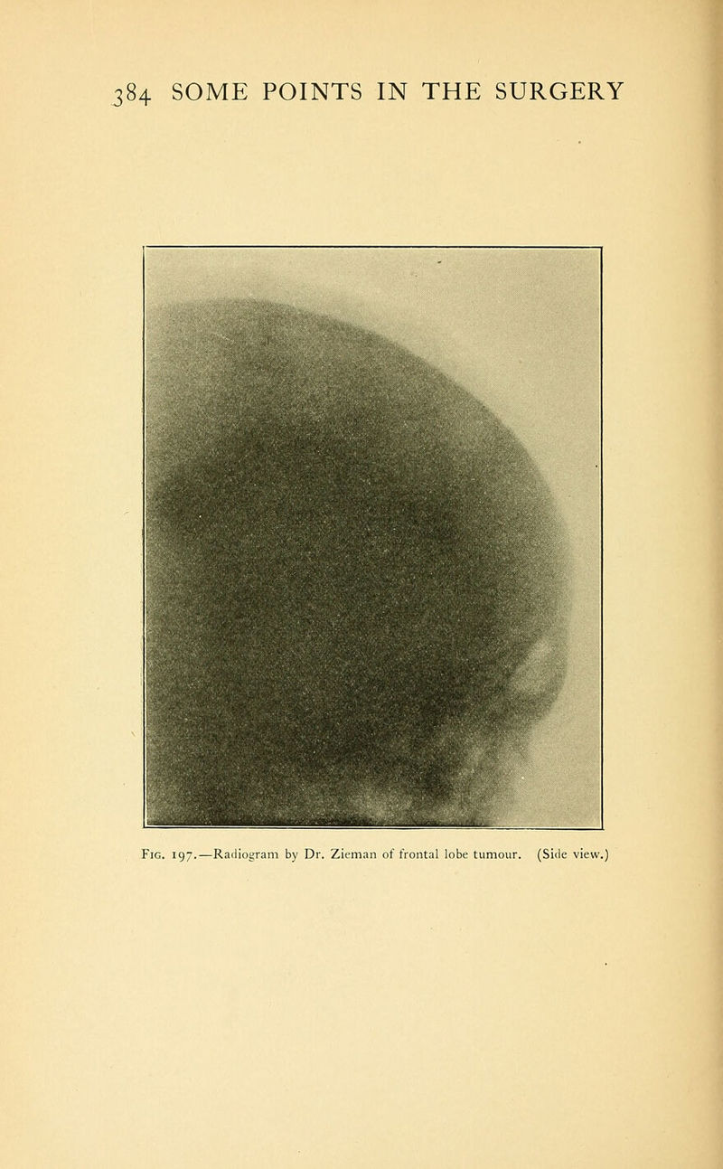i i Fig. 197.—Radiogram by Dr. Zieman of frontal lobe tumour. (Side viev