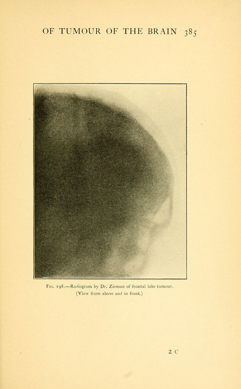 Fig. 198.—Radiogram by Dr. Zieman of frontal lobe tumour. (View from above and in front.) 2 C