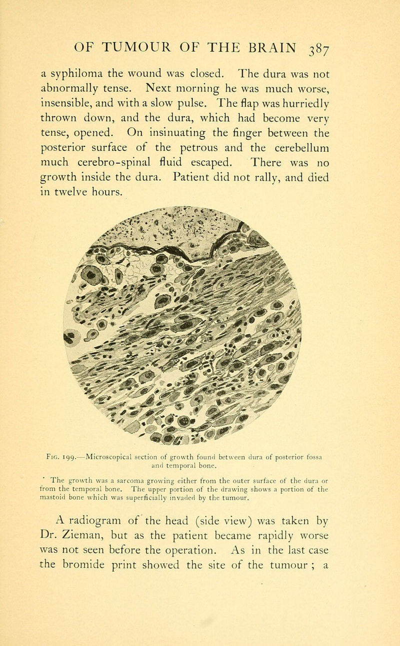 a syphiloma the wound was closed. The dura was not abnormally tense. Next morning he was much worse, insensible, and with a slow pulse. The flap was hurriedly thrown down, and the dura, which had become very tense, opened. On insinuating the finger between the posterior surface of the petrous and the cerebellum much cerebro-spinal fluid escaped. There was no growth inside the dura. Patient did not rally, and died in twelve hours. ^ y^' Fig. 199.—Microscopical section of growth found between dura of posterior fossa and temporal bone. The growth was a sarcoma growing either from the outer surface of the dura or from the temporal bone. The upper portion of the drawing shows a portion of the mastoid bone which was superficially invaded by the tumour. A radiogram of the head (side view) was taken by Dr. Zieman, but as the patient became rapidly worse was not seen before the operation. As in the last case the bromide print showed the site of the tumour ; a