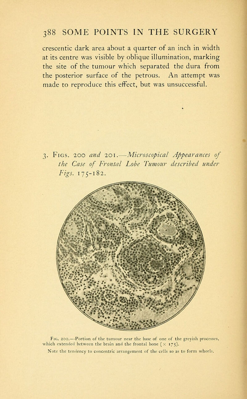crescentic dark area about a quarter of an inch in width at its centre was visible by obHque illumination, marking the site of the tumour which separated the dura from the posterior surface of the petrous. An attempt was made to reproduce this efFect, but was unsuccessful. Figs. 200 and 201.—Microscopical Appearances of the Case of Frontal Lobe Tumour described under Figs. 175-182. Fig. 200.—Portion of the tumour near the base of one of the greyish processes, which extended between the brain and the frontal bone (x 175). Note the tendency to concentric arrangement of the cells so as to form whorls.