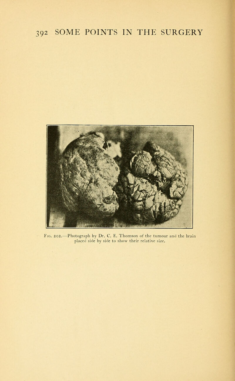 Fig. 202.—Photograph by Dr. C. E. Thomson of the tumour and the brain placed side by side to show their relative size.